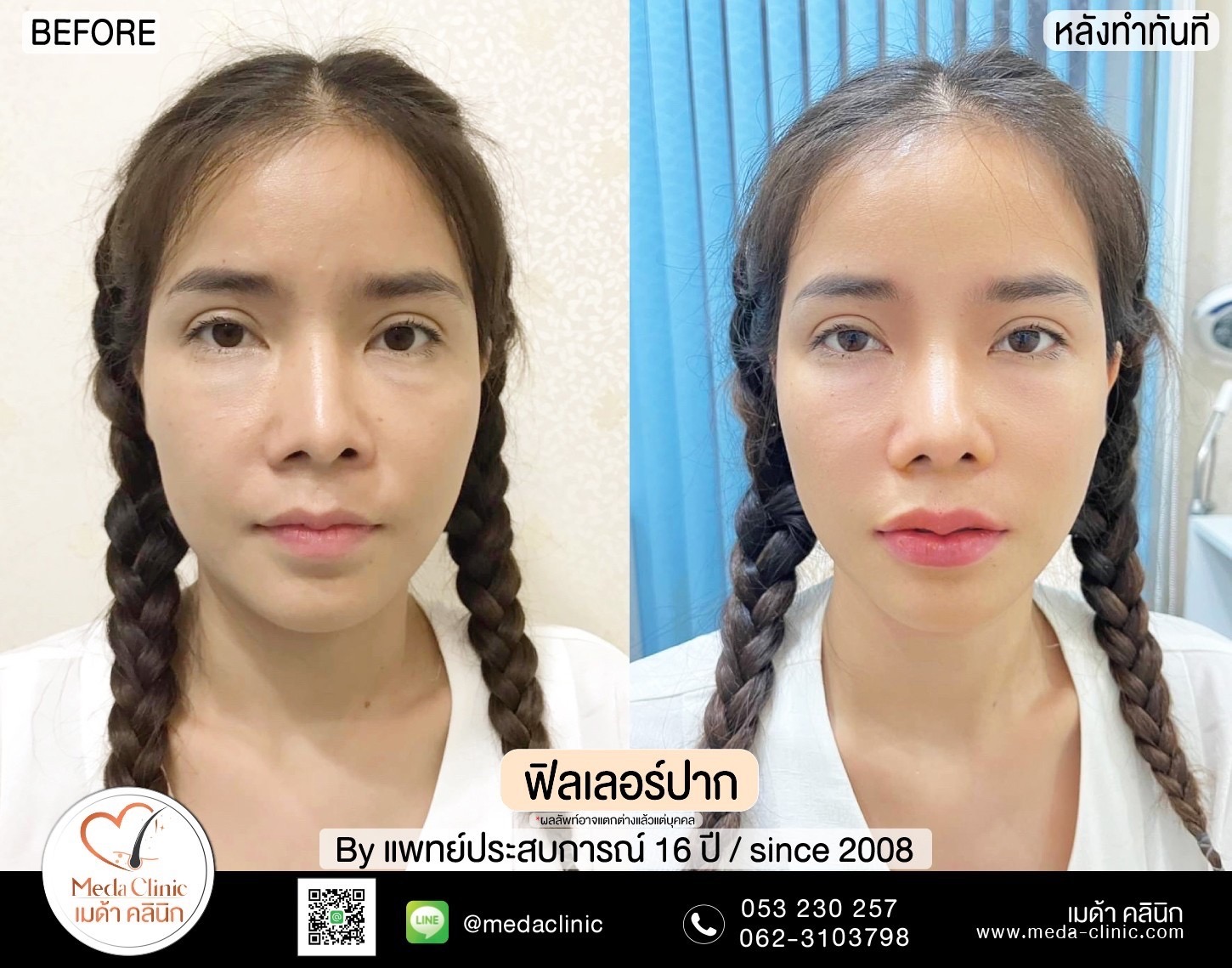 ฟิลเลอร์ปากเชียงใหม่