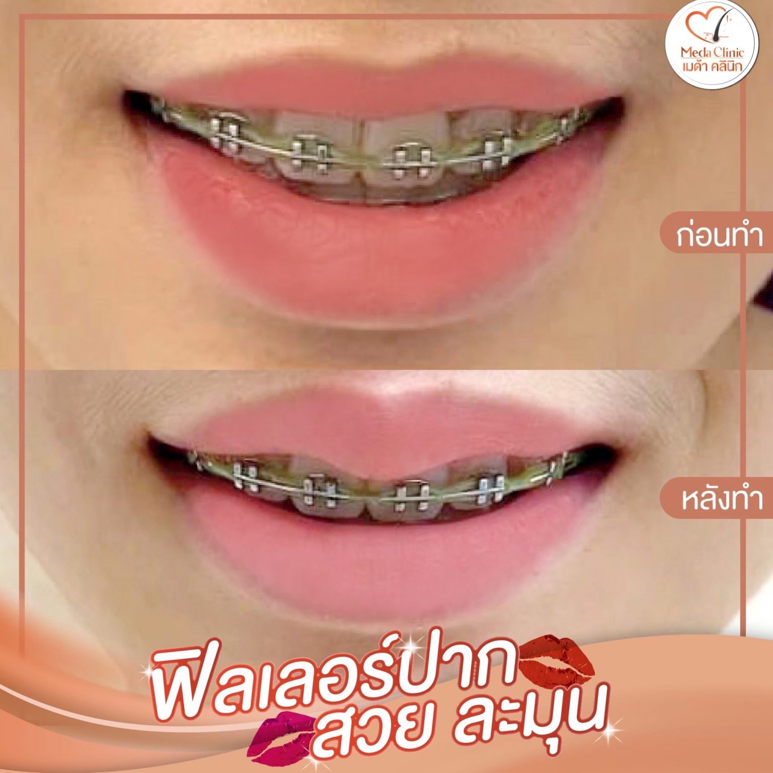 ฟิลเลอร์ปากเชียงใหม่