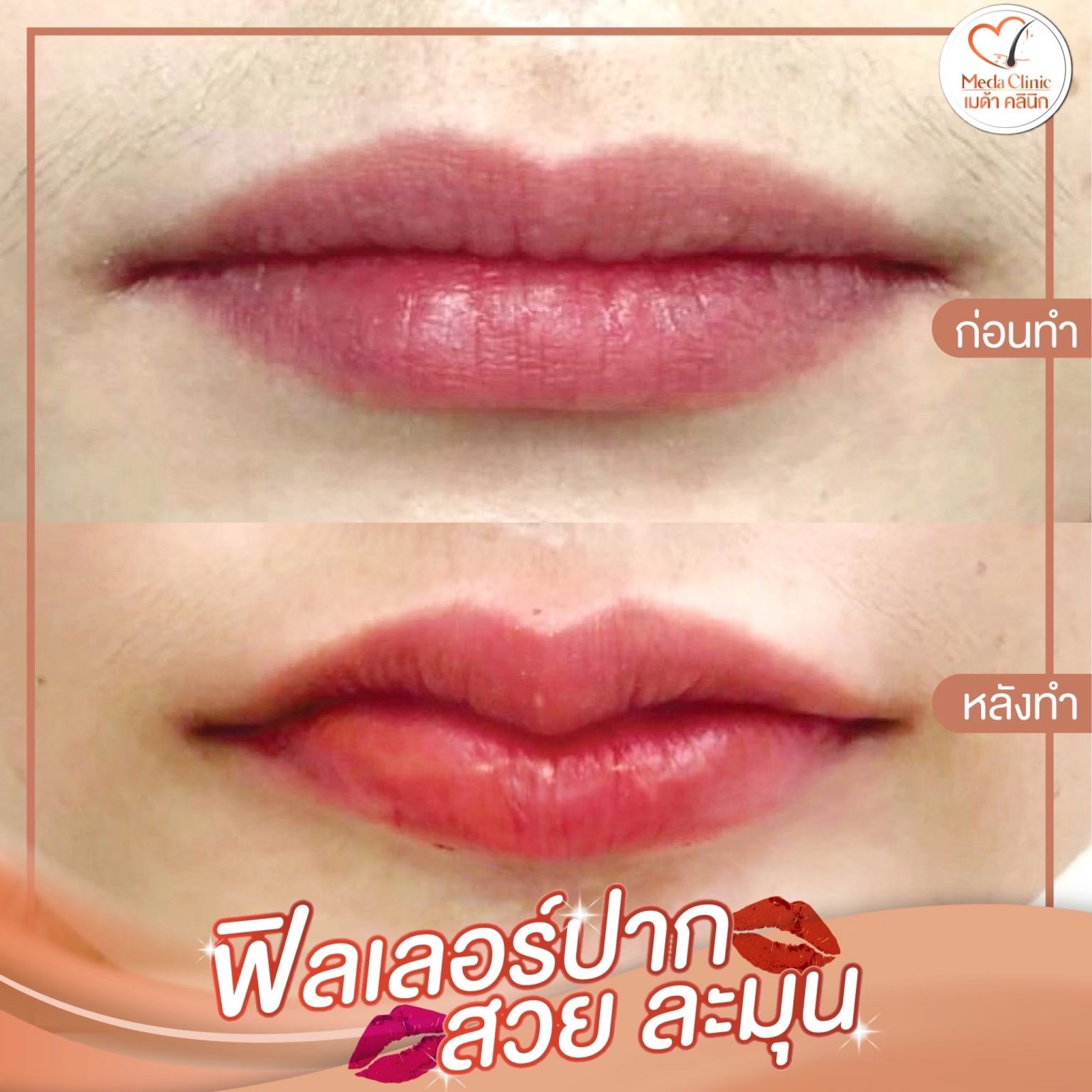 ฟิลเลอร์ปากเชียงใหม่