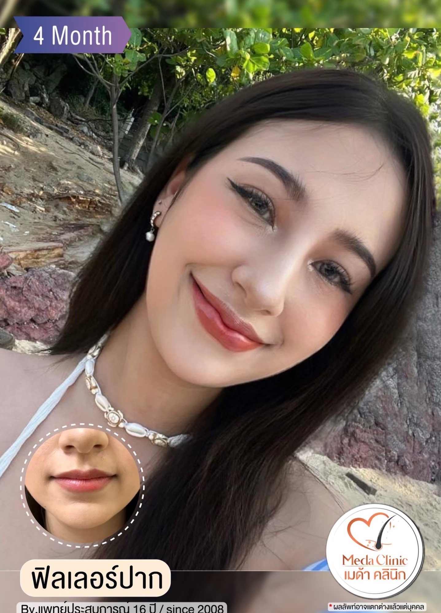 ฟิลเลอร์ปากเชียงใหม่