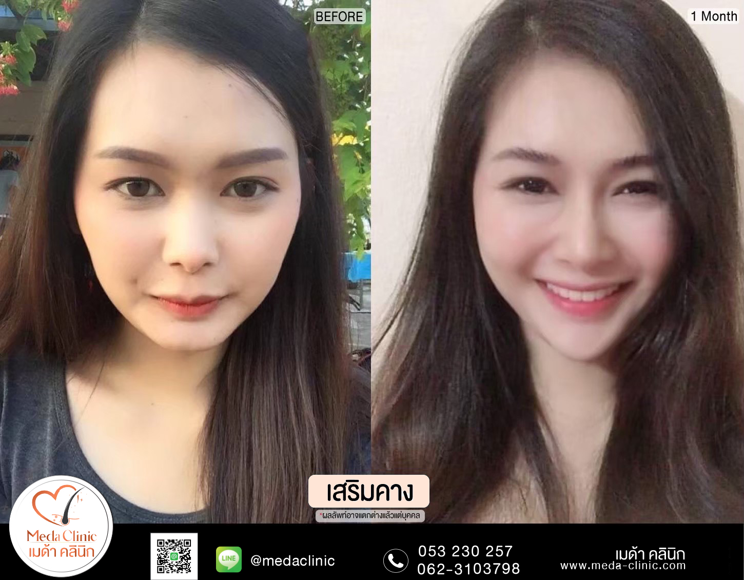 แก้คางเชียงใหม่