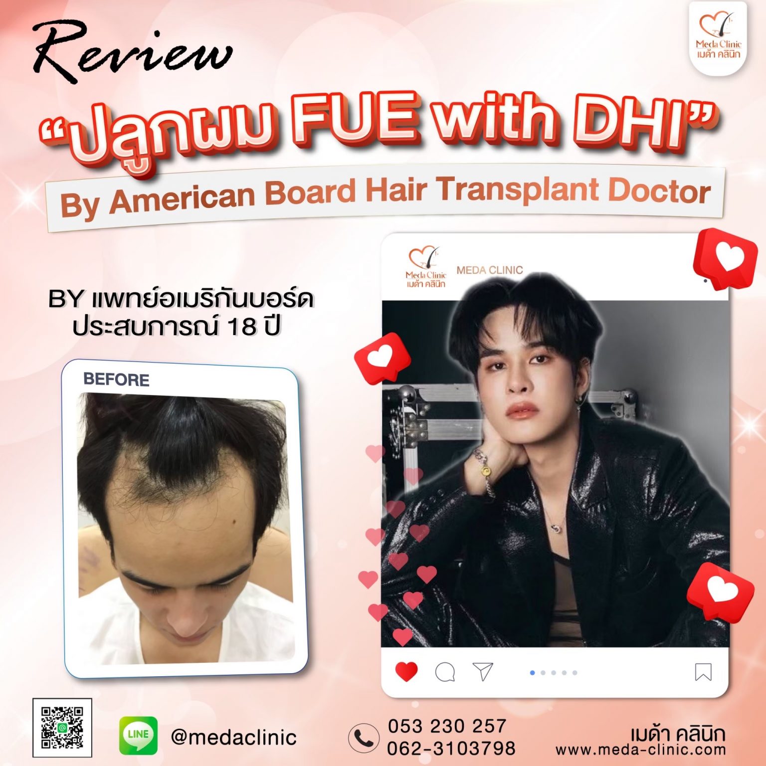 ปลูกคิ้ว เชียงใหม่
