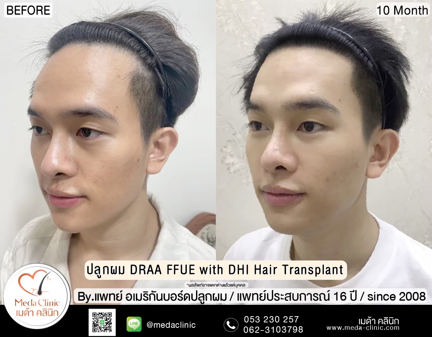 ปลูกคิ้ว เชียงใหม่