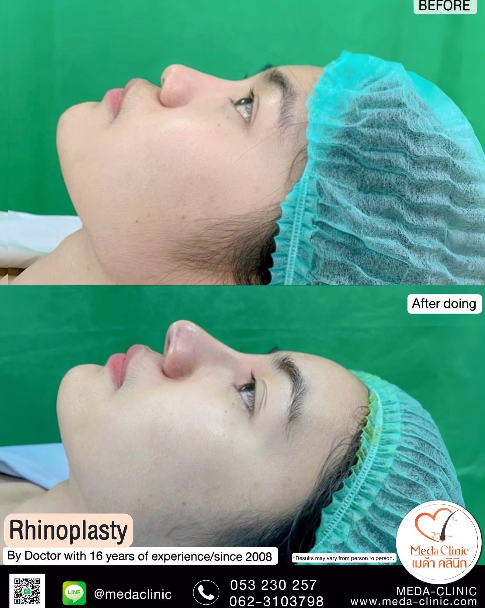alarplasty