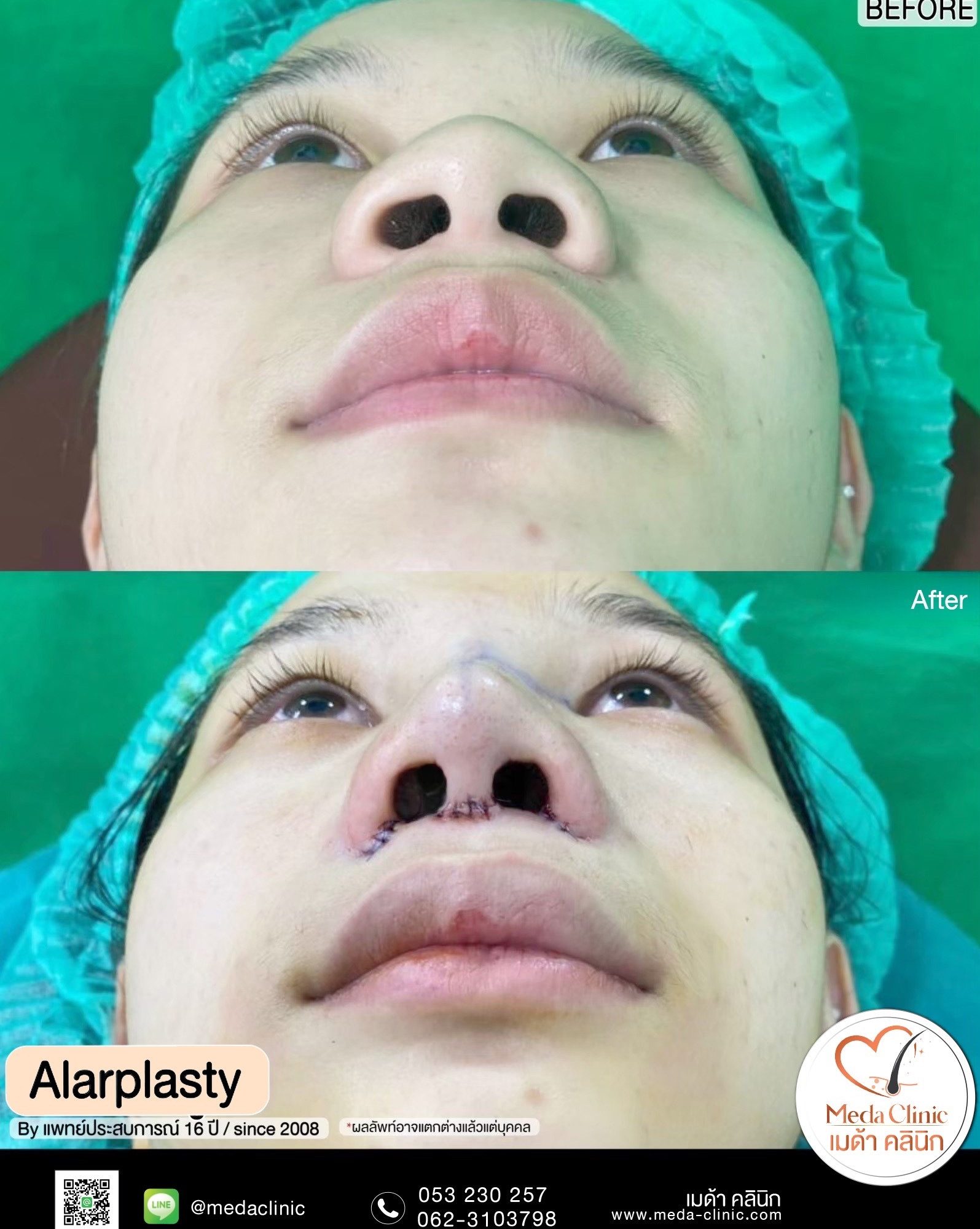 alarplasty