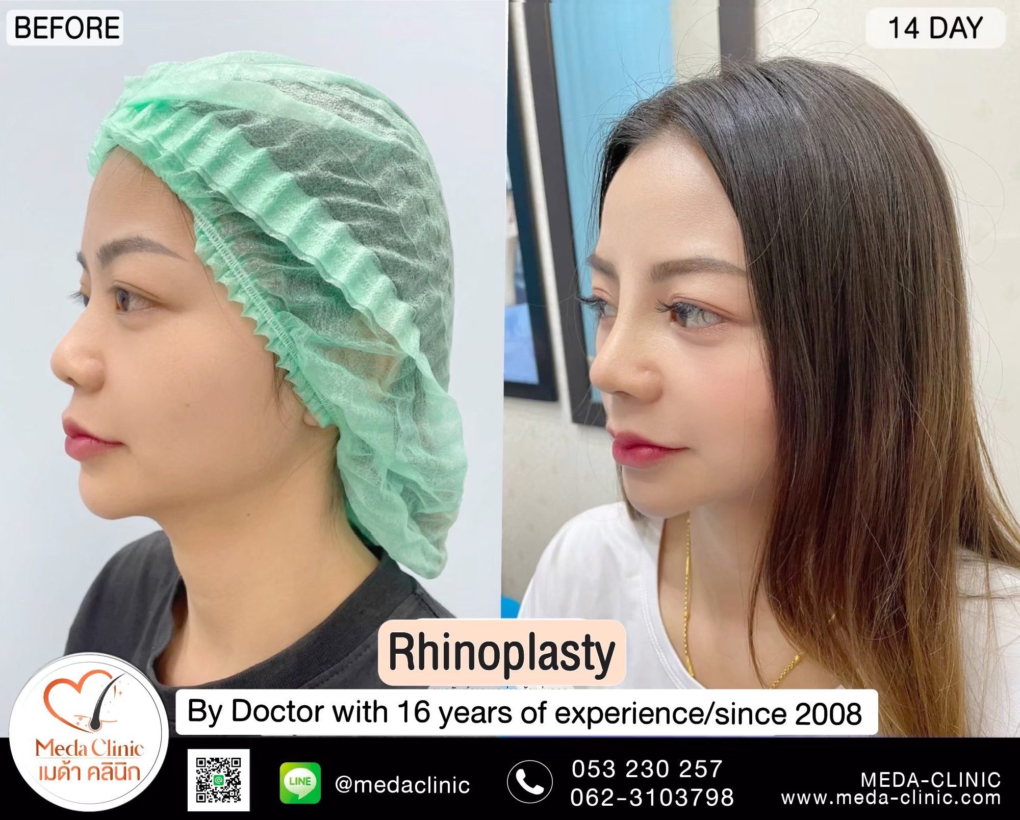 alarplasty