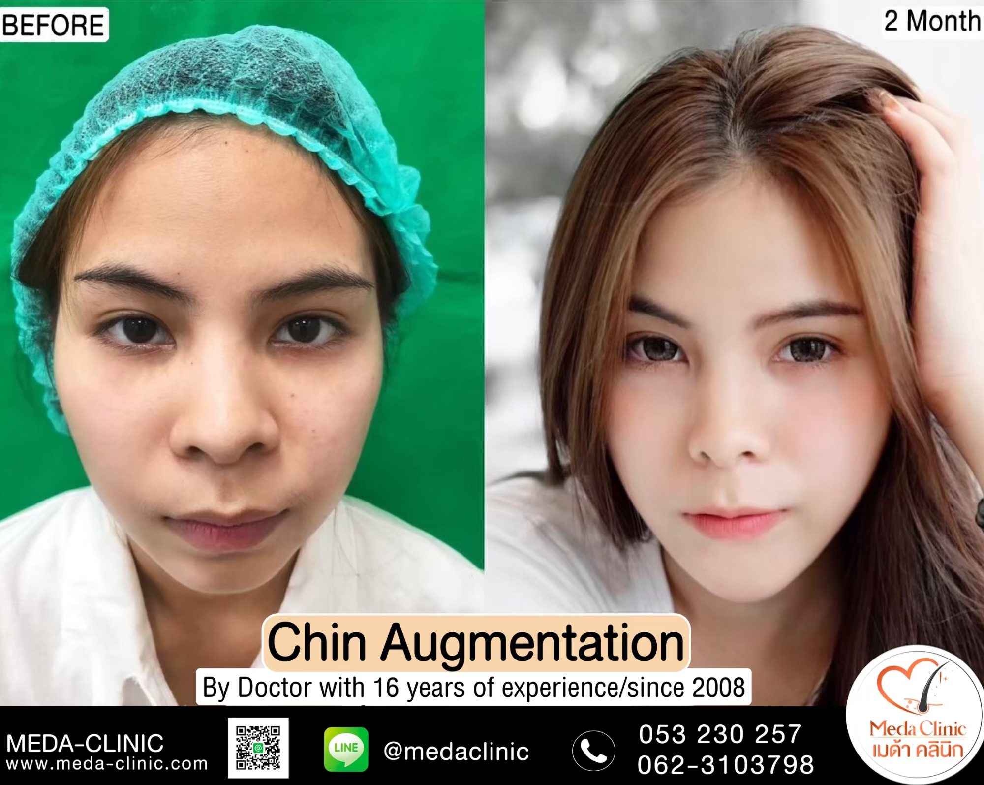 Plastic surgery Chiangmai