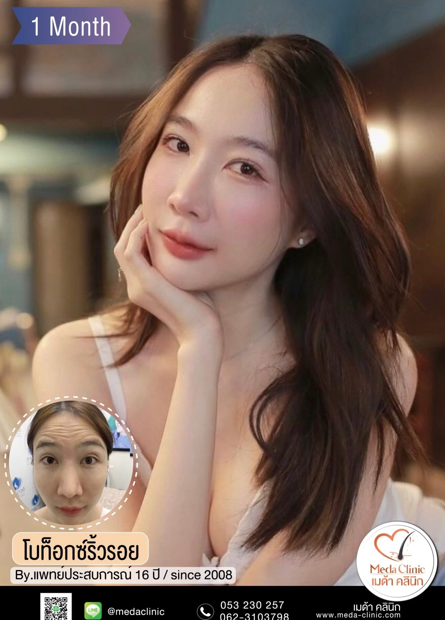 ฉีดโบท็อก