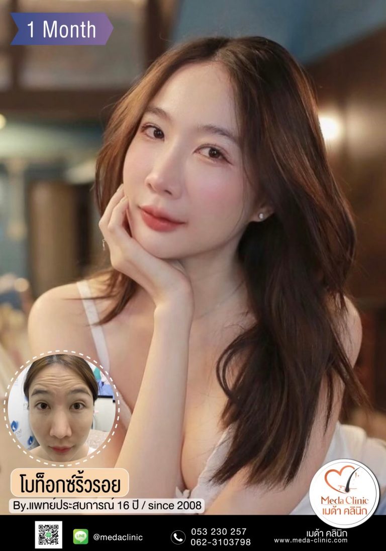 ฉีดโบท็อก