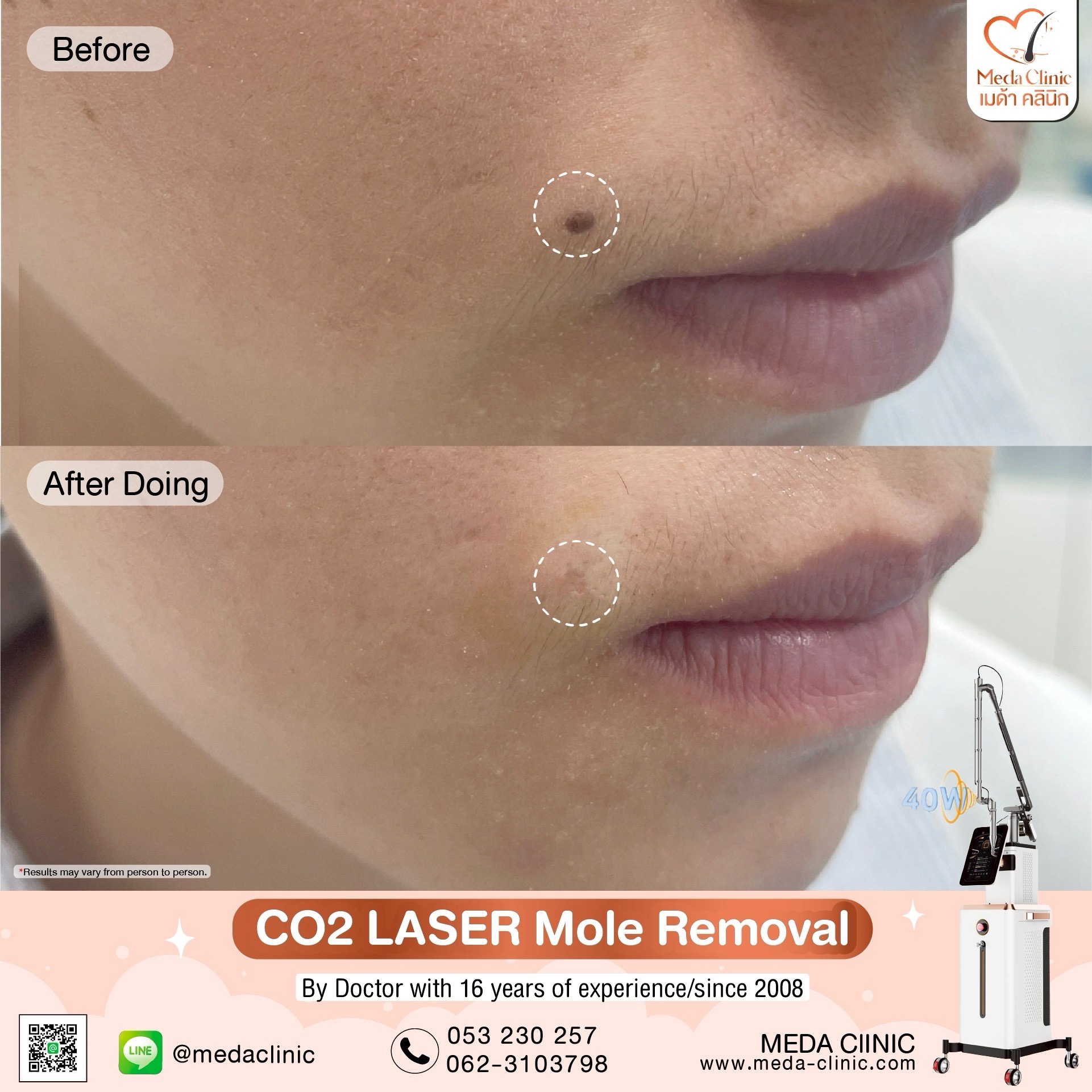 Mole removal