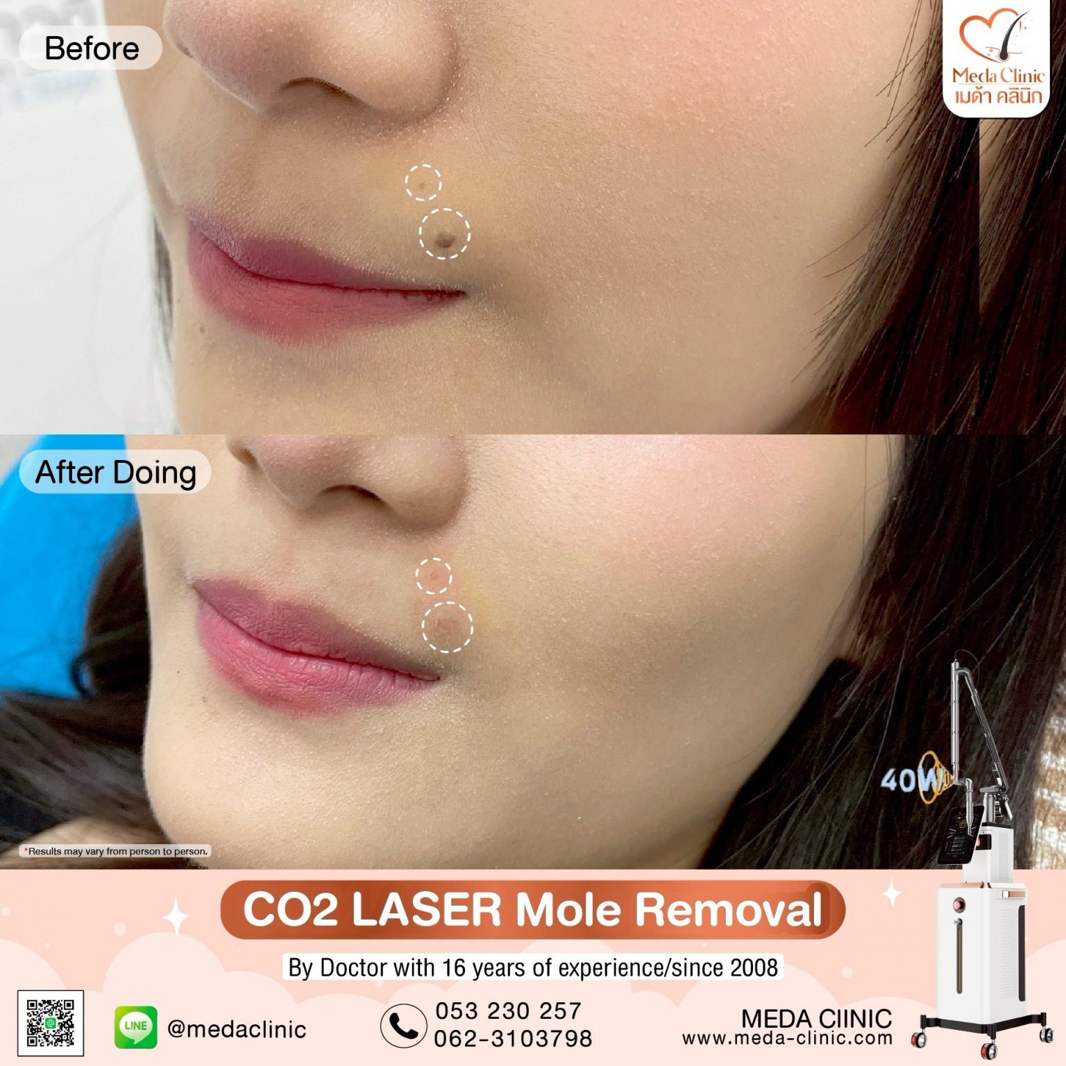Mole removal
