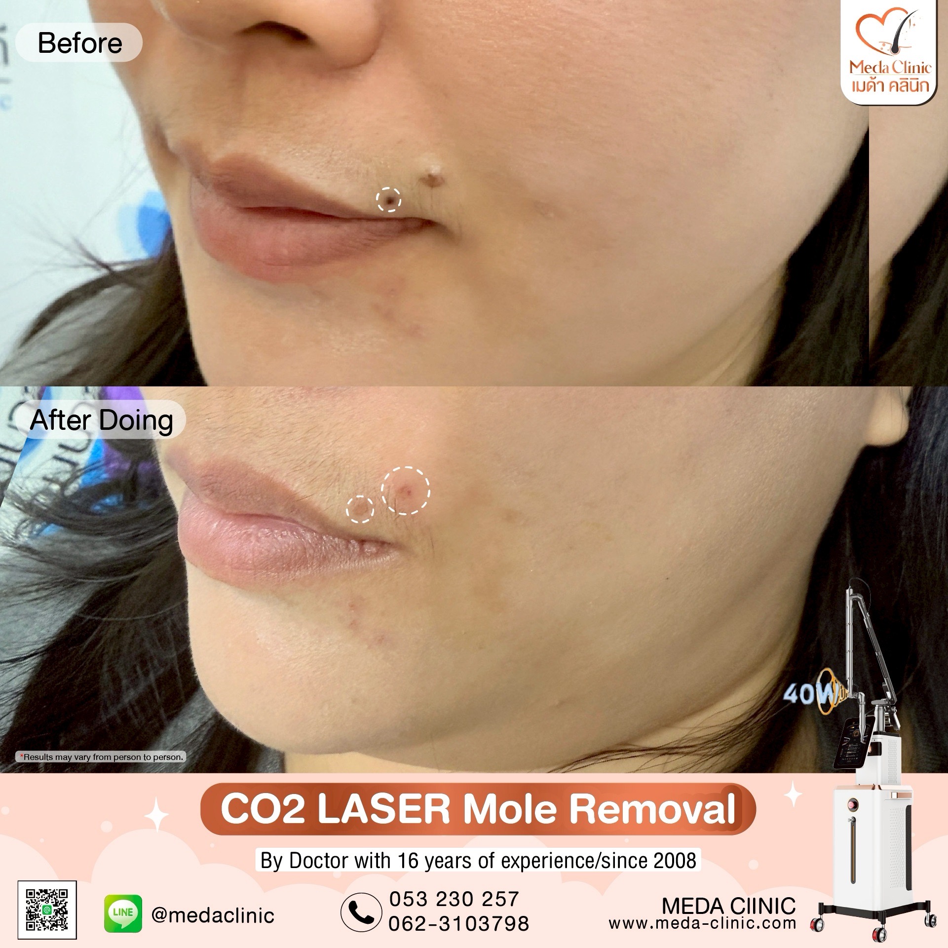 Mole removal