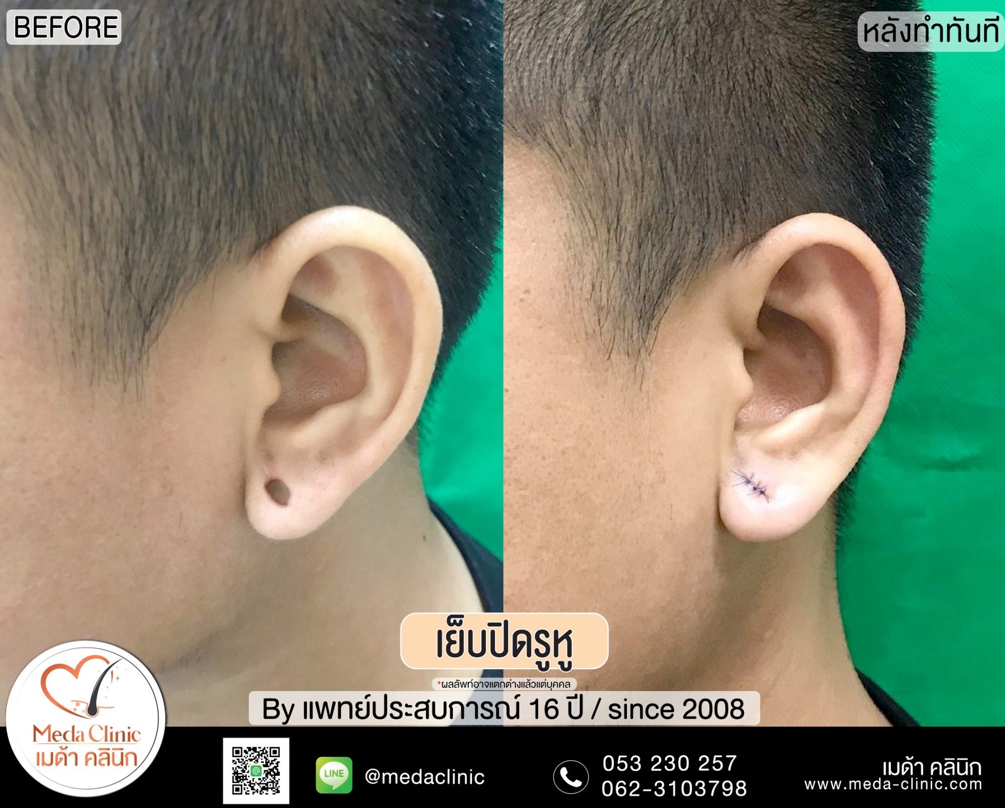 การเย็บปิดรูหู