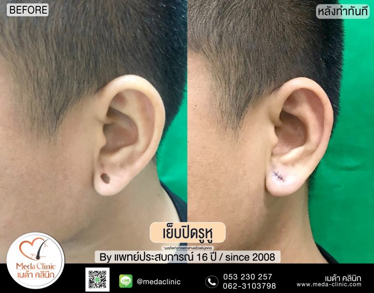 การเย็บปิดรูหู