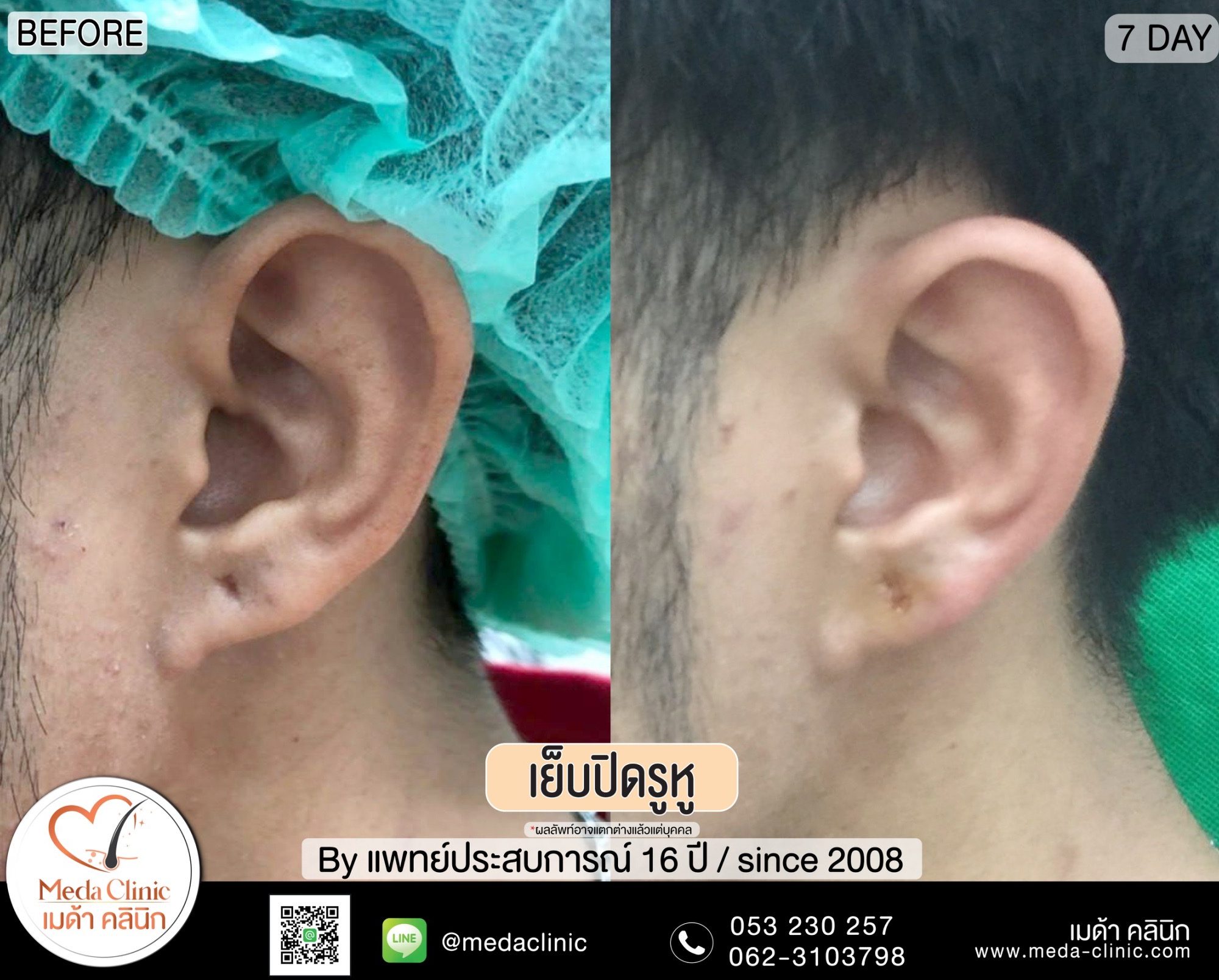 การเย็บปิดรูหู