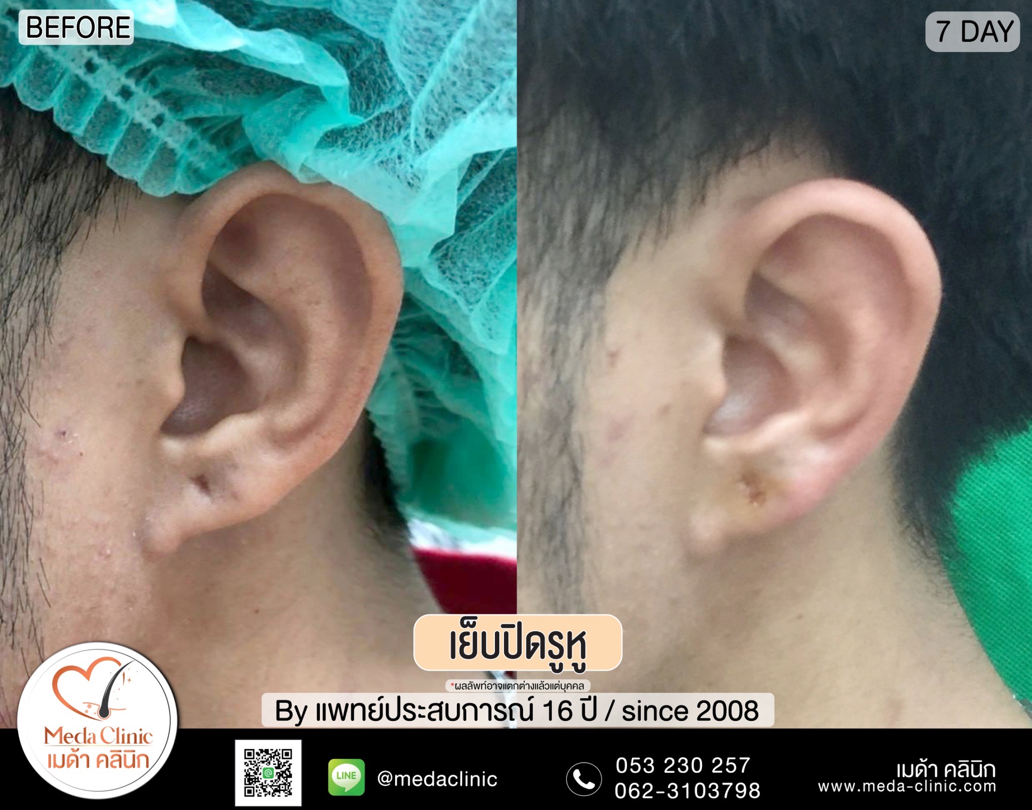 การเย็บปิดรูหู