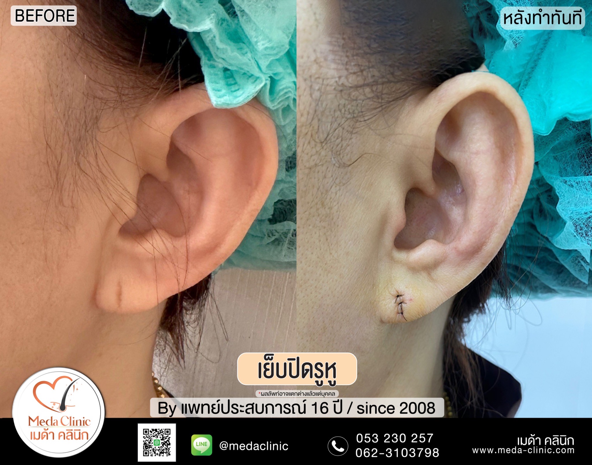 การเย็บปิดรูหู