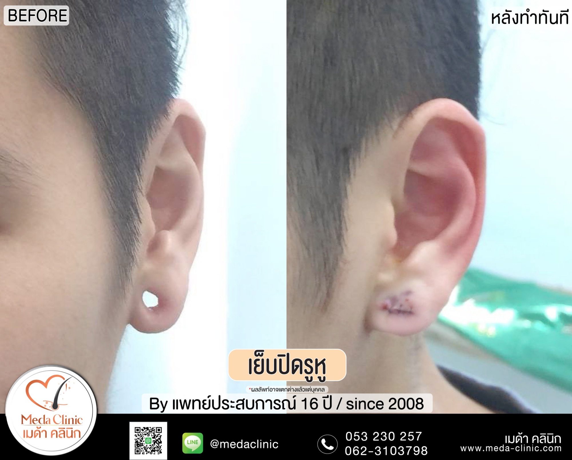การเย็บปิดรูหู