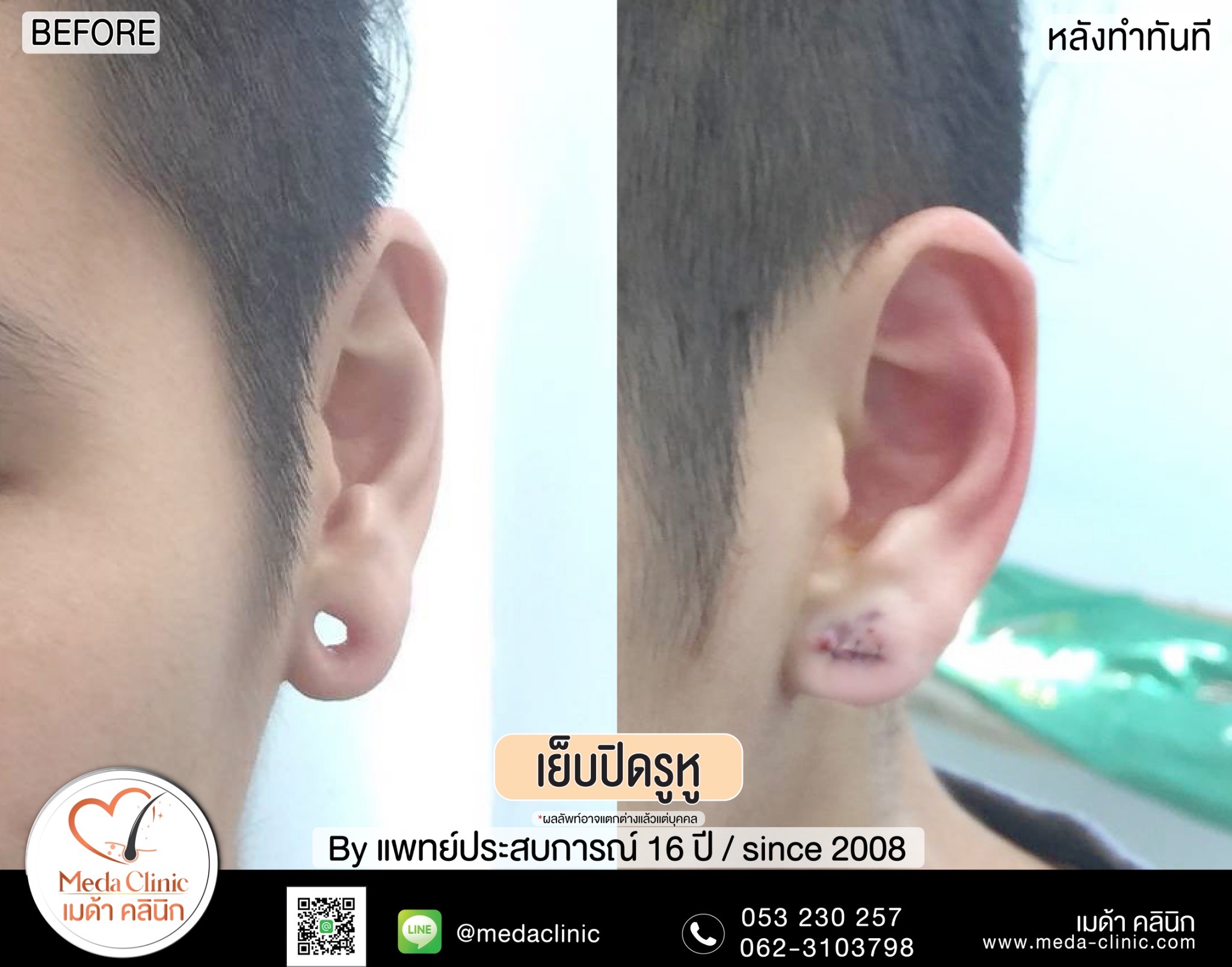 การเย็บปิดรูหู