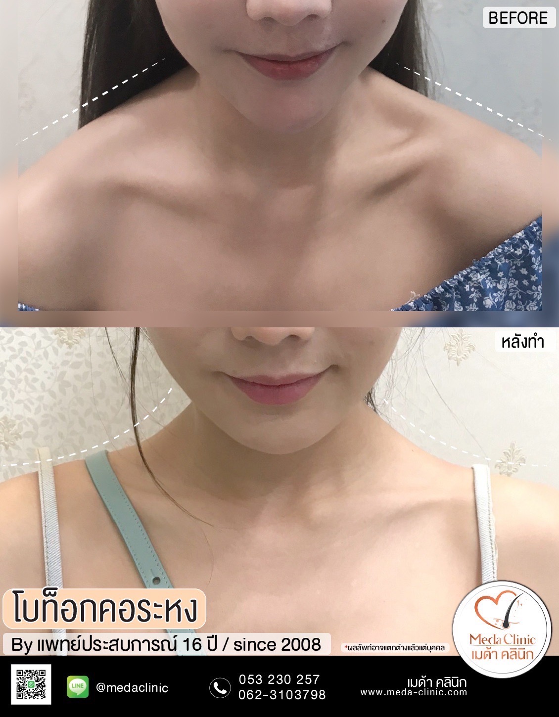 ฉีดคอระหงเชียงใหม่