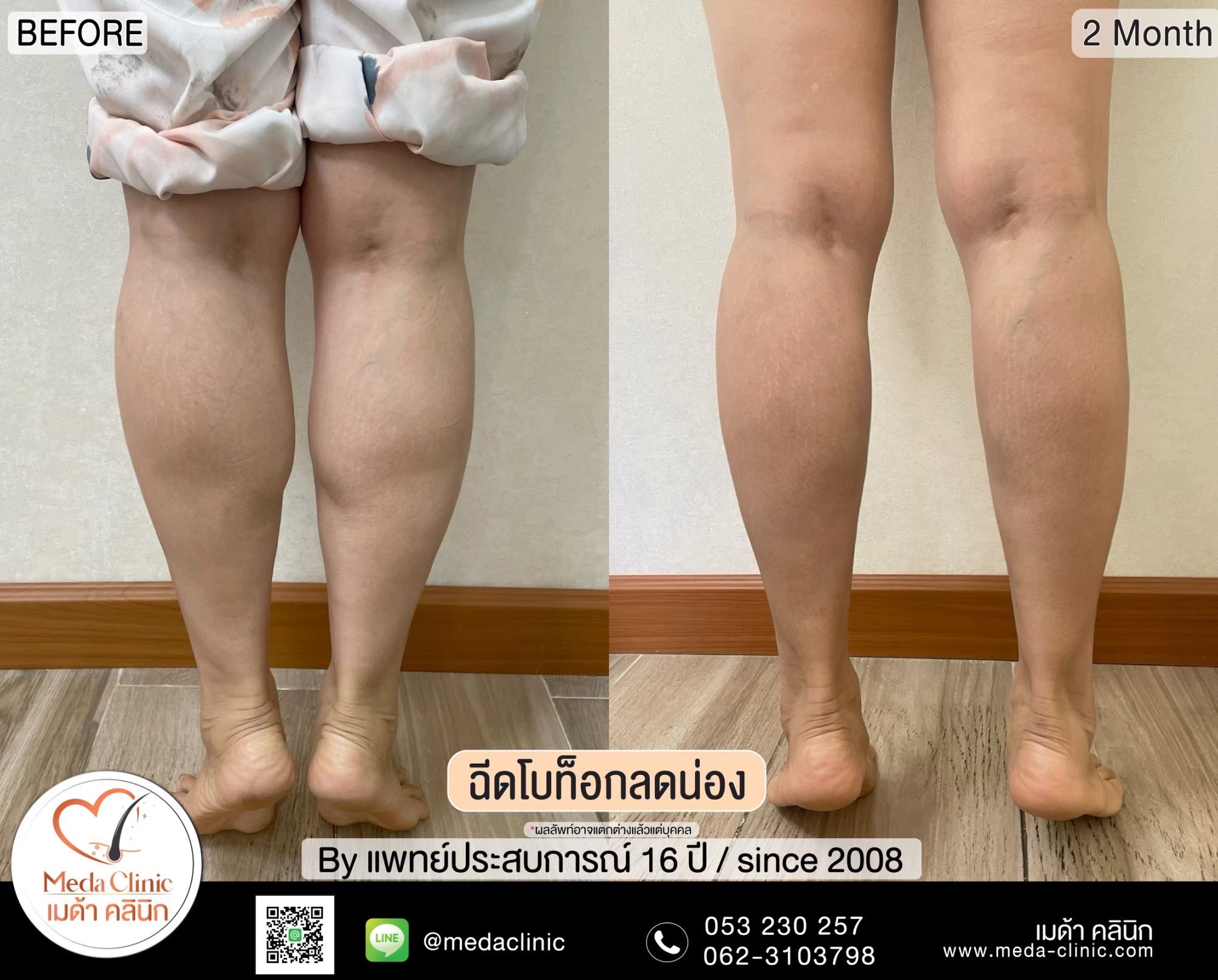 การฉีดโบท็อกซ์