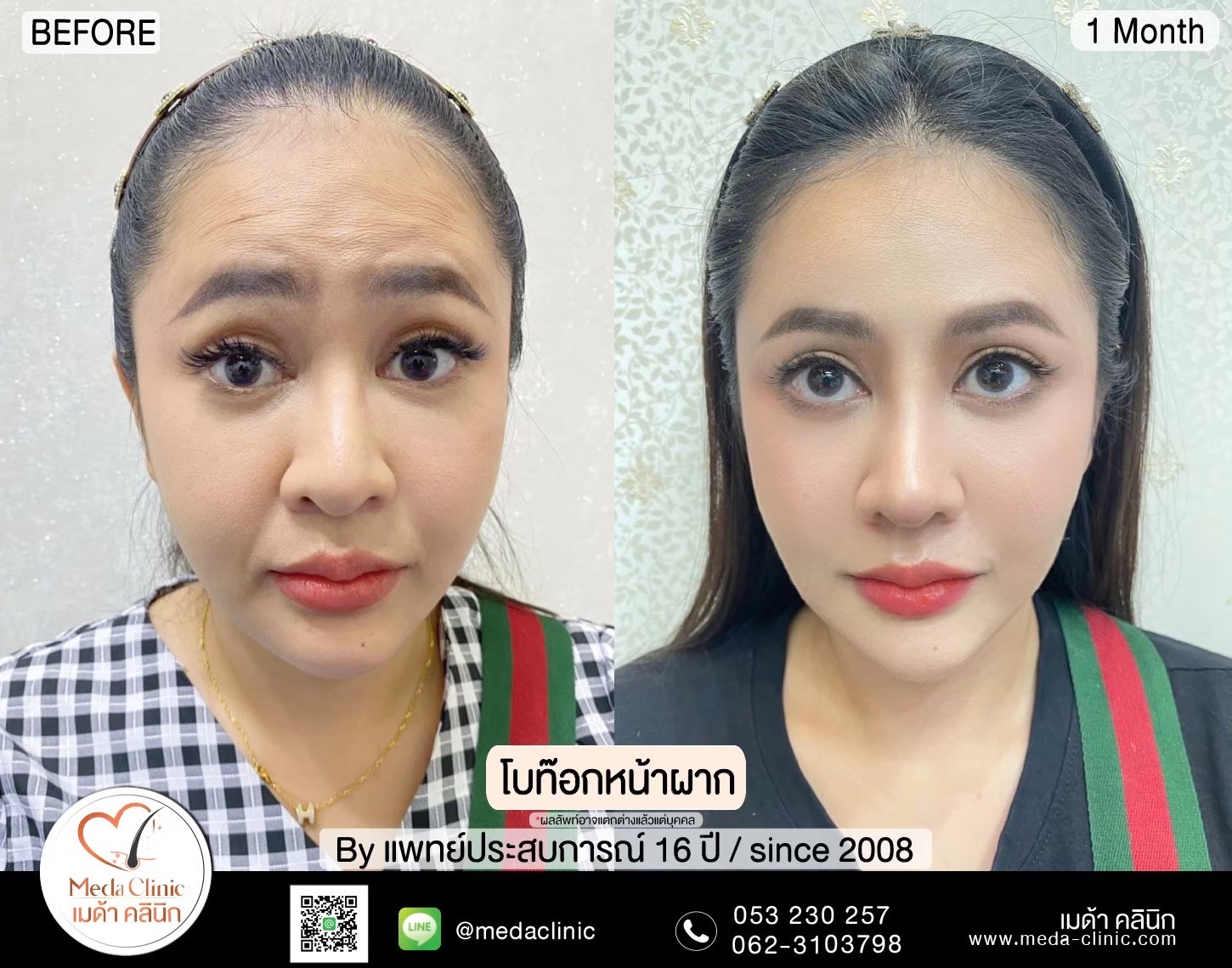 ฉีดโบท็อกซ์น่อง