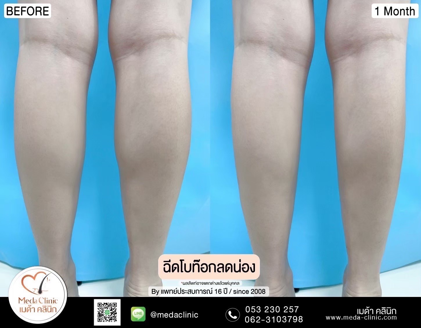 ฉีดโบท็อกซ์น่อง