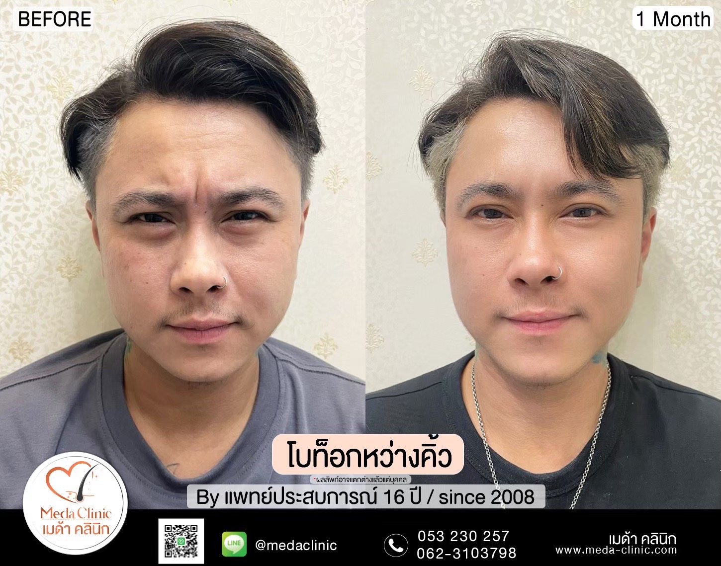 ฉีดโบท็อกซ์น่อง