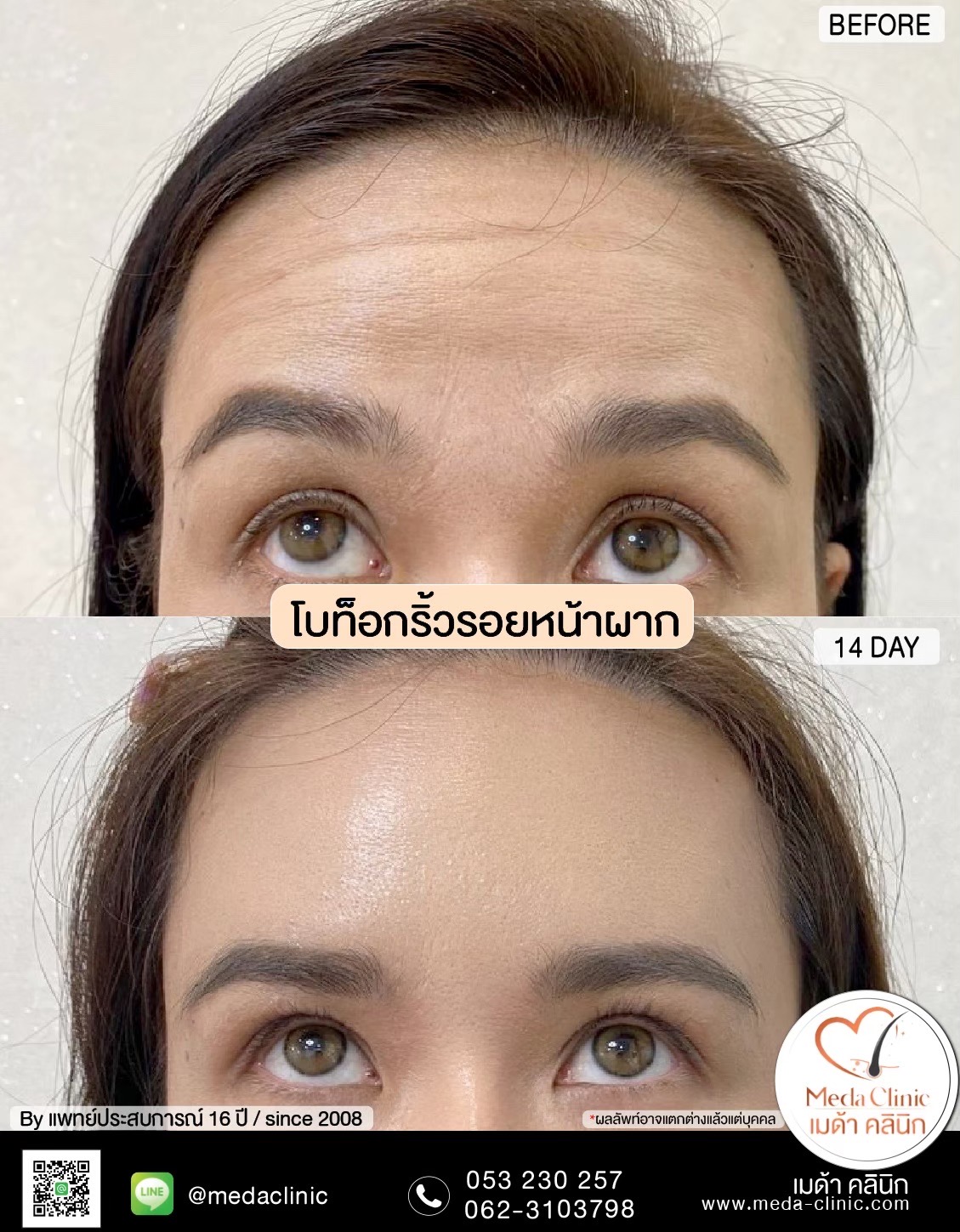 ฉีดโบท็อกซ์น่อง