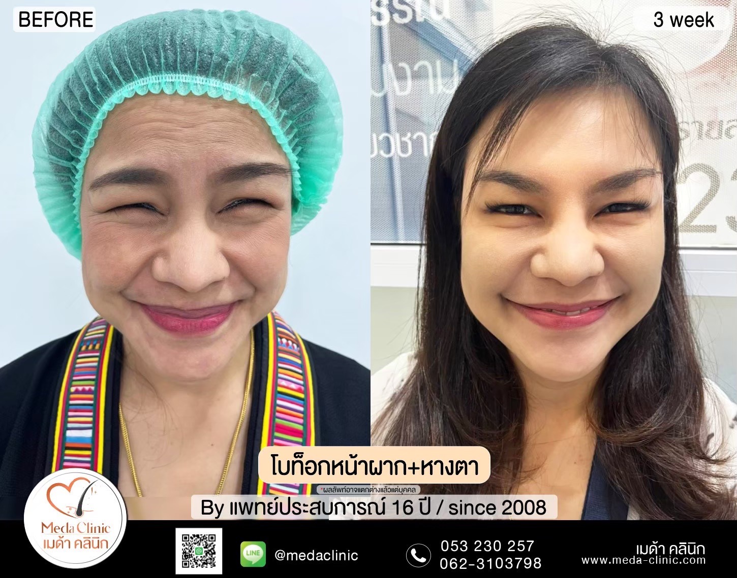 ฉีดโบท็อกซ์น่อง