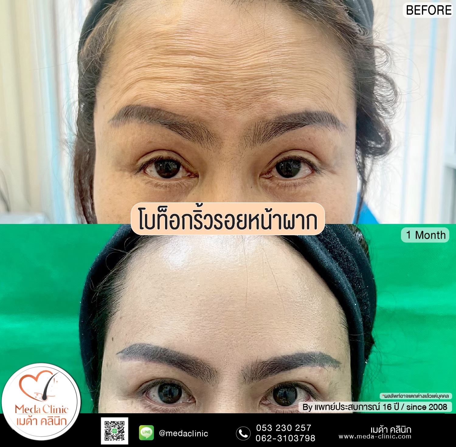 ฉีดโบท็อกซ์น่อง