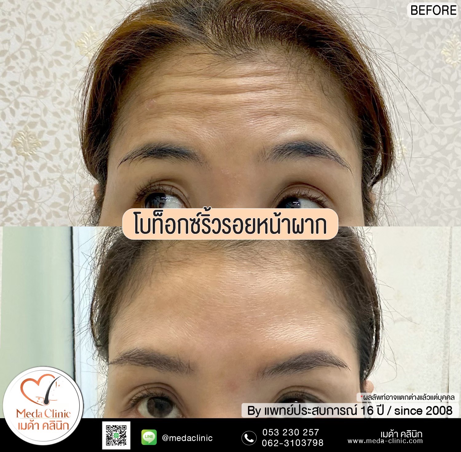ฉีดโบท็อกซ์น่อง