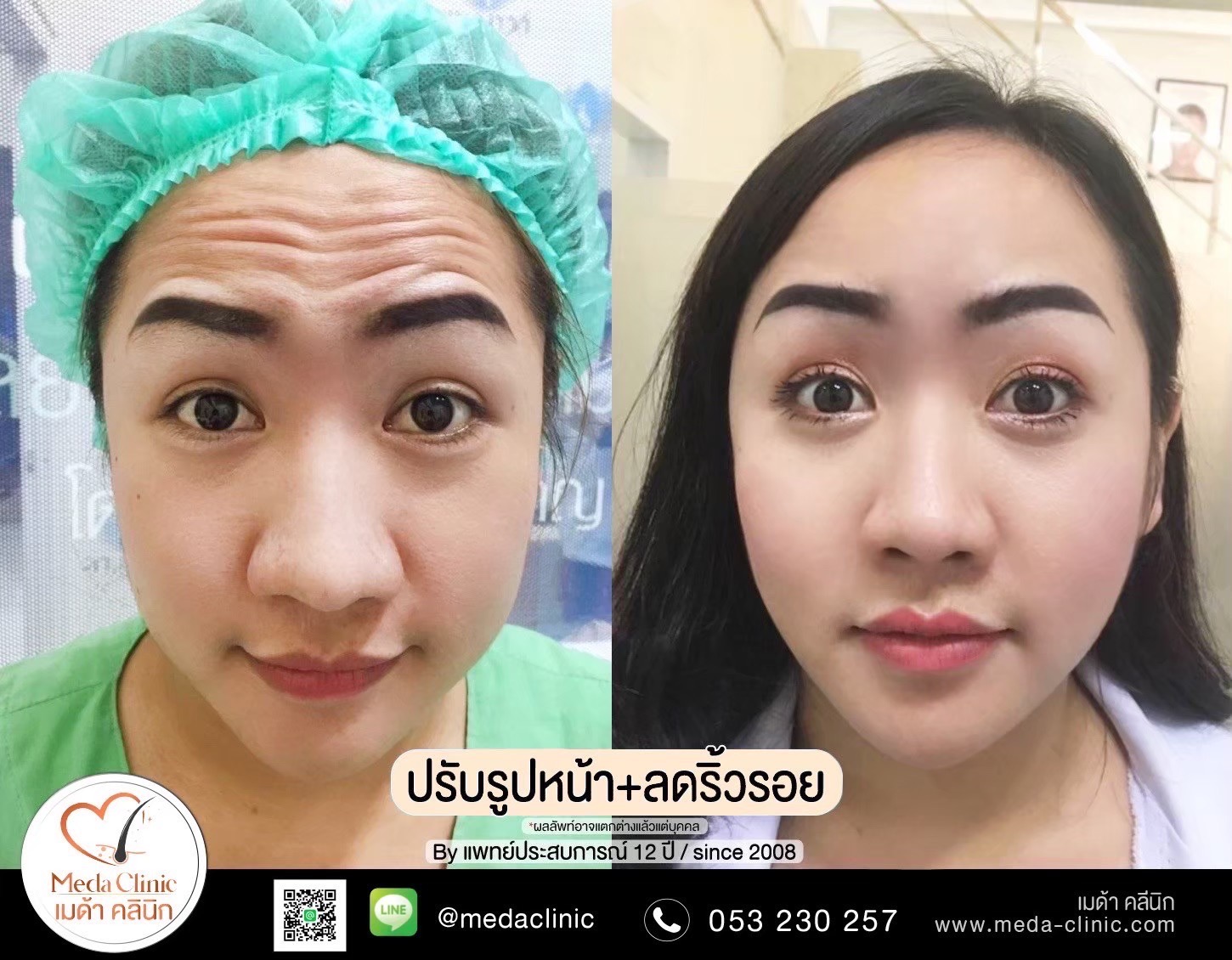 โบท็อกลดน่องเชียงใหม่