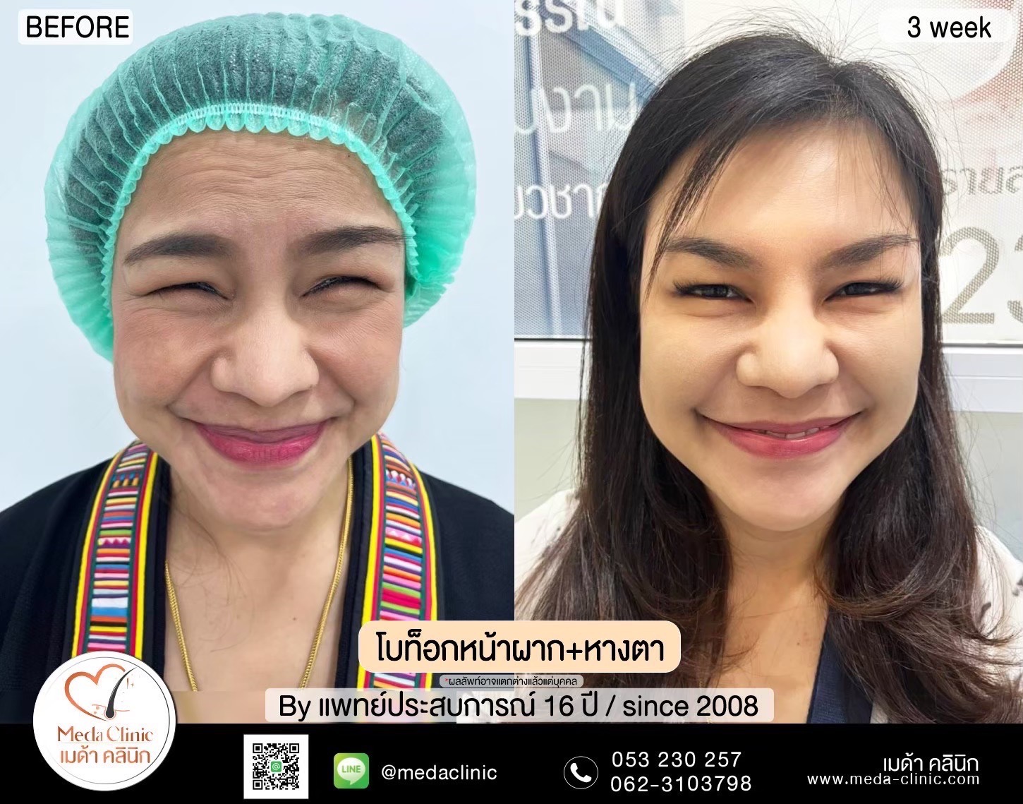 โบท็อกลดน่องเชียงใหม่