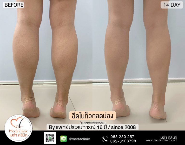 การฉีดโบท็อก