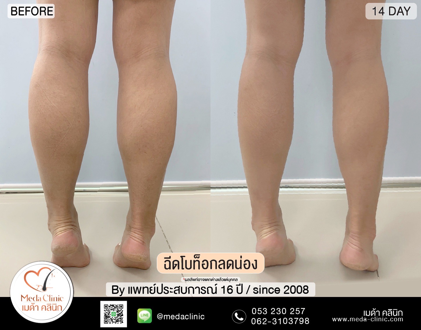การฉีดโบท็อก