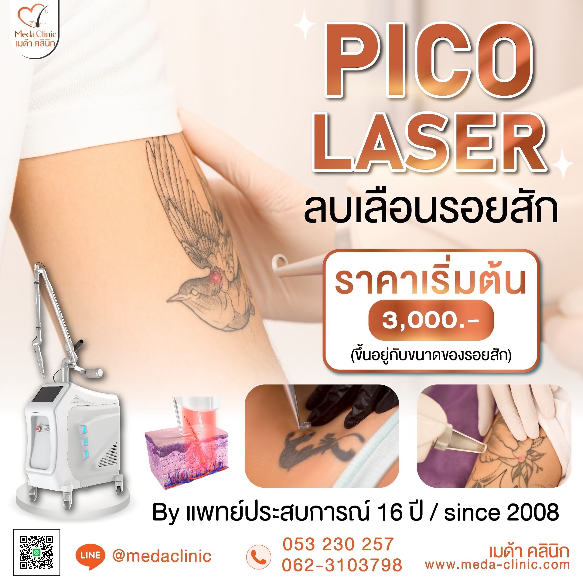 ลบรอยสัก