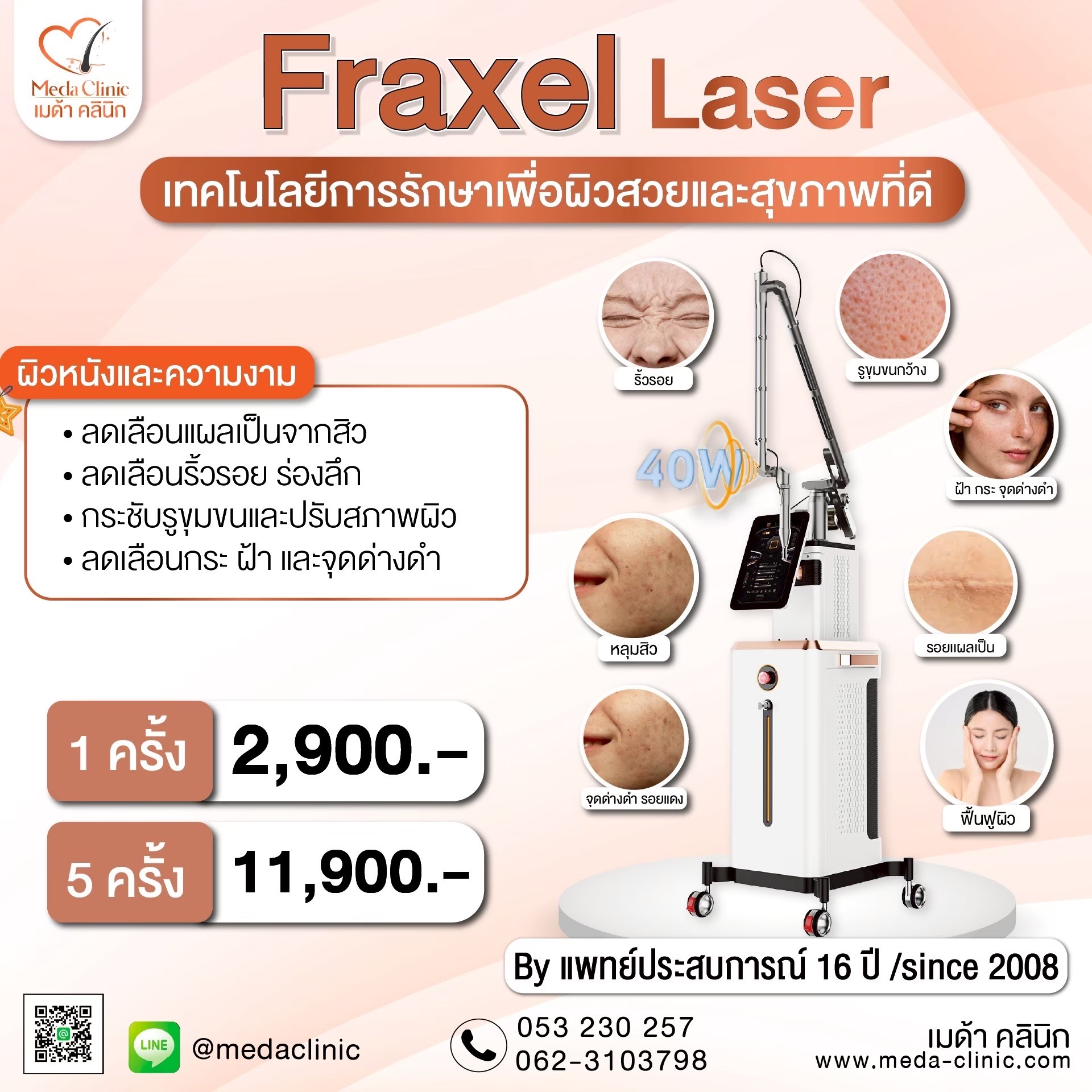 เลเซอร์หลุมสิวที่ไหนดี