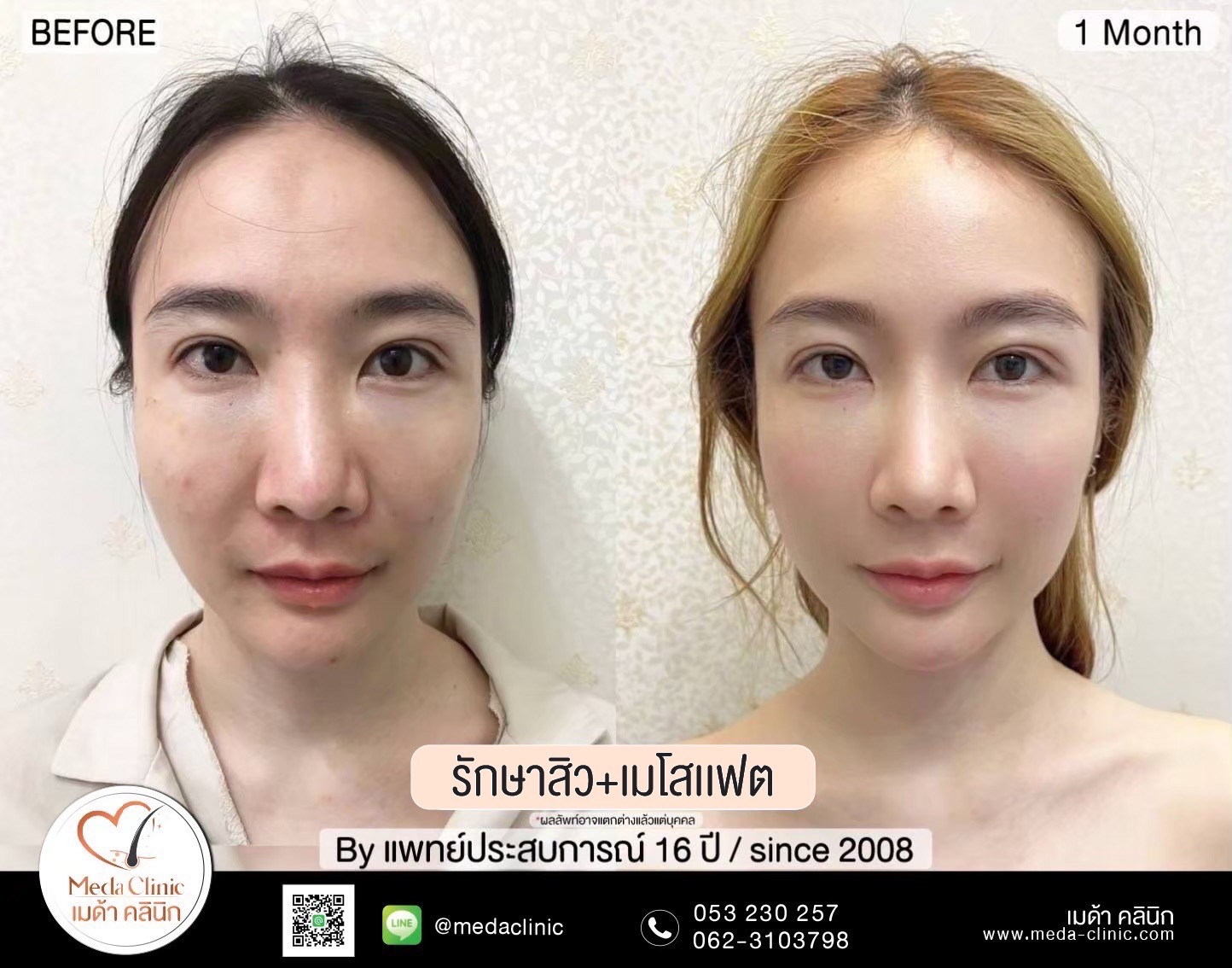 เลเซอร์หลุมสิวที่ไหนดี