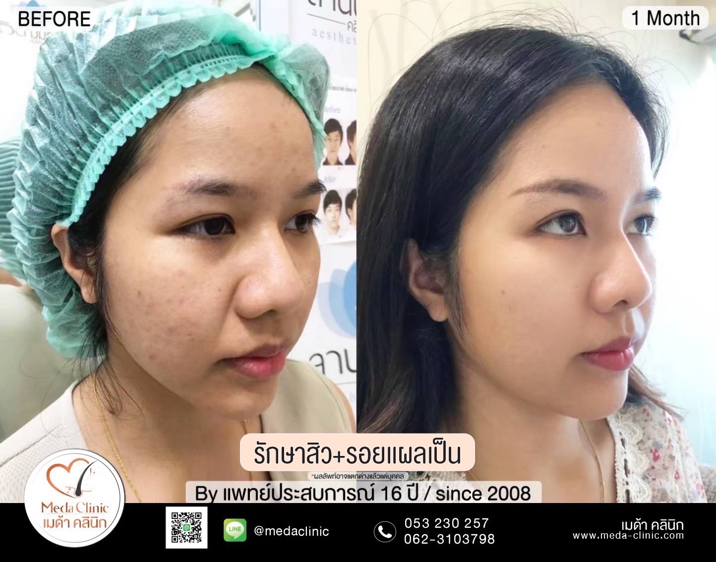 เลเซอร์หลุมสิวที่ไหนดี