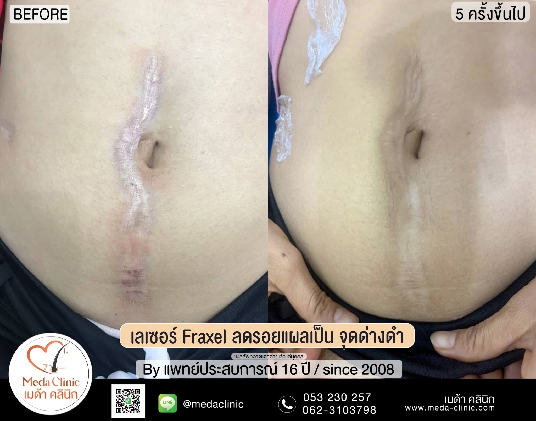 เลเซอร์หลุมสิวที่ไหนดี