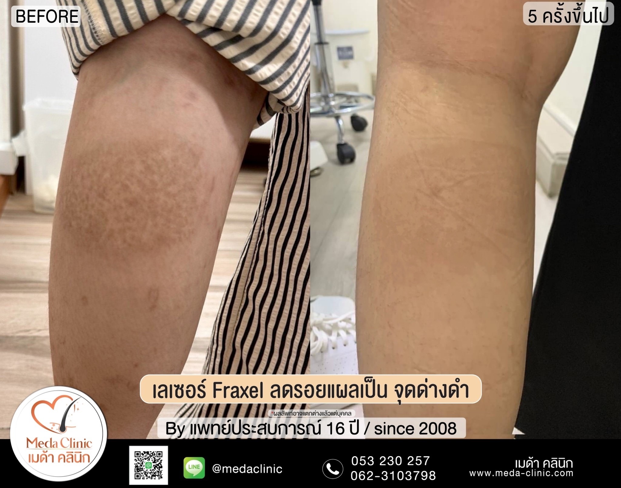 เลเซอร์หลุมสิวที่ไหนดี