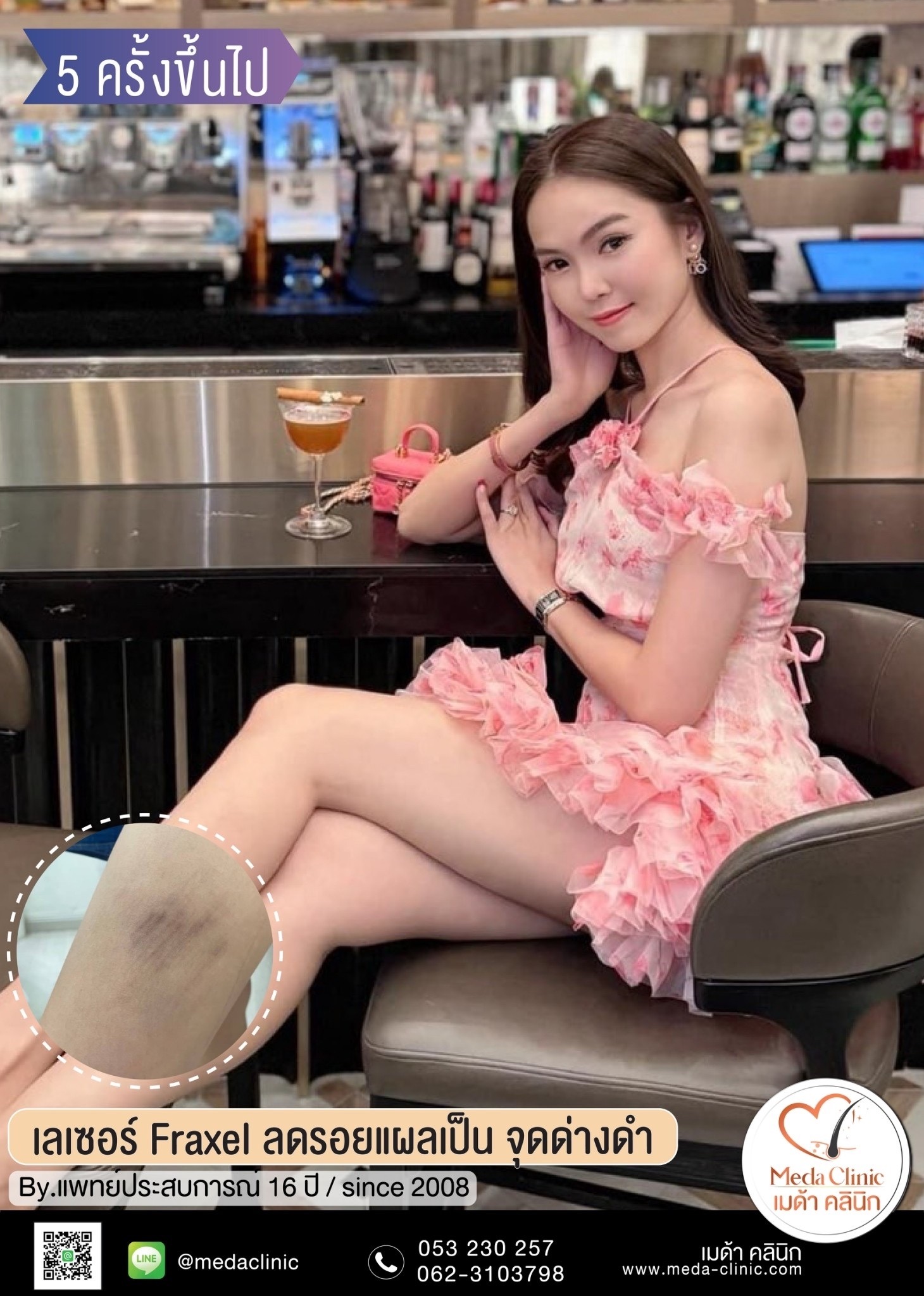 เลเซอร์หลุมสิวที่ไหนดี