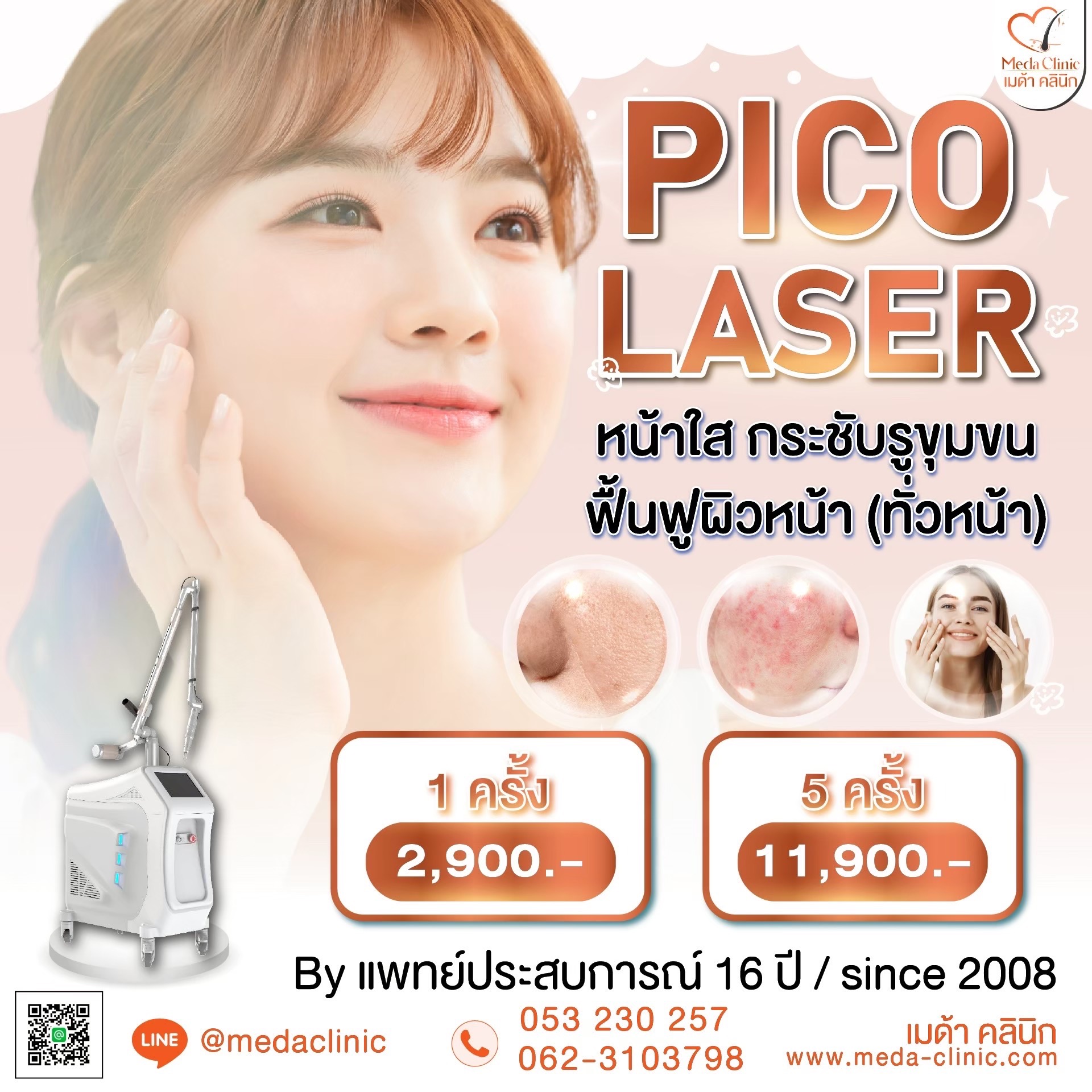 เลเซอร์หลุมสิว