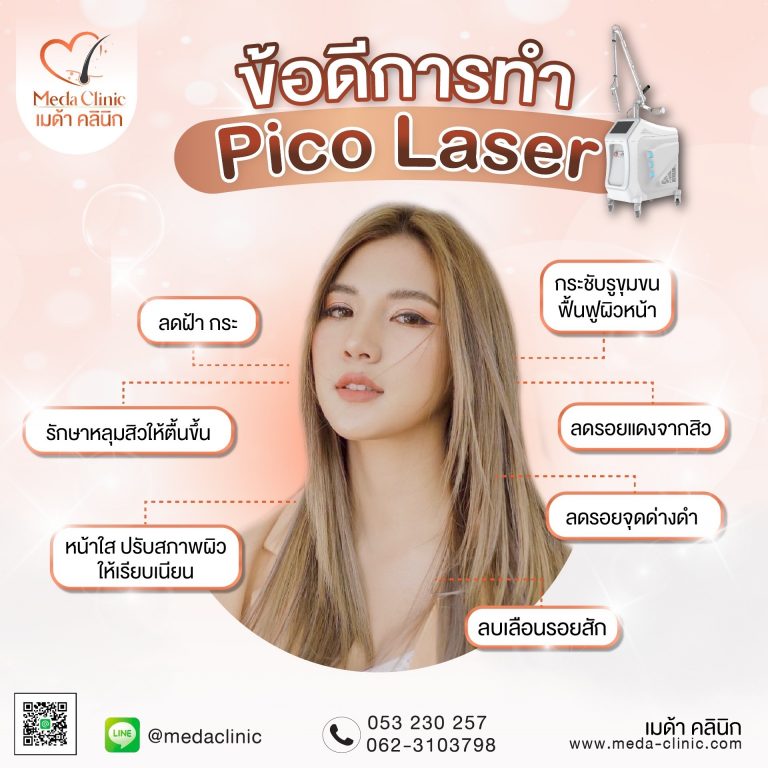 เลเซอร์หลุมสิว