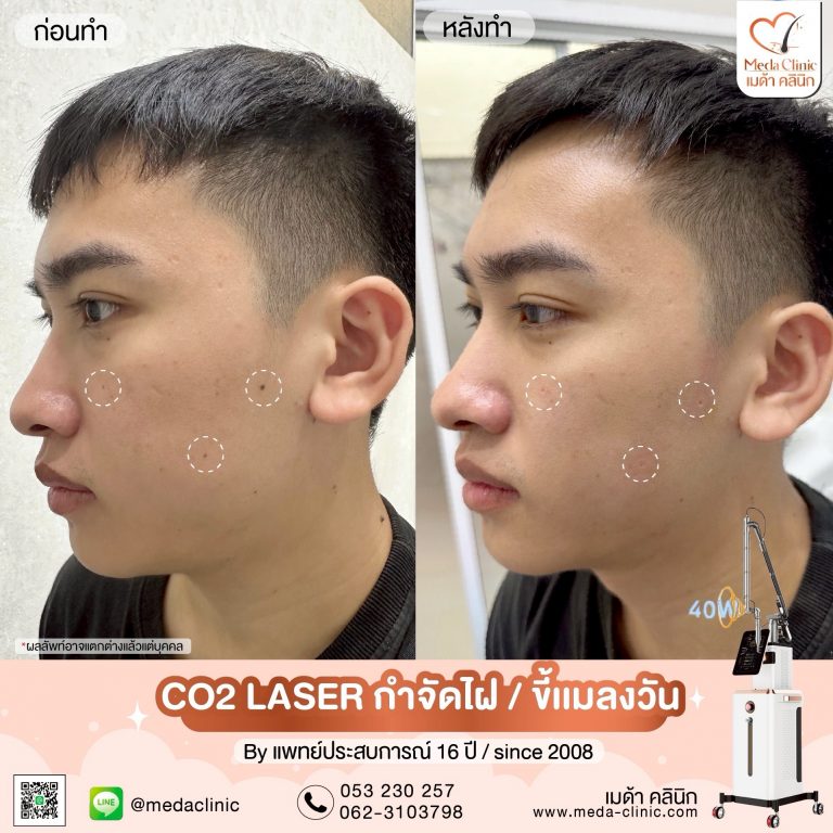 จี้ไฝ