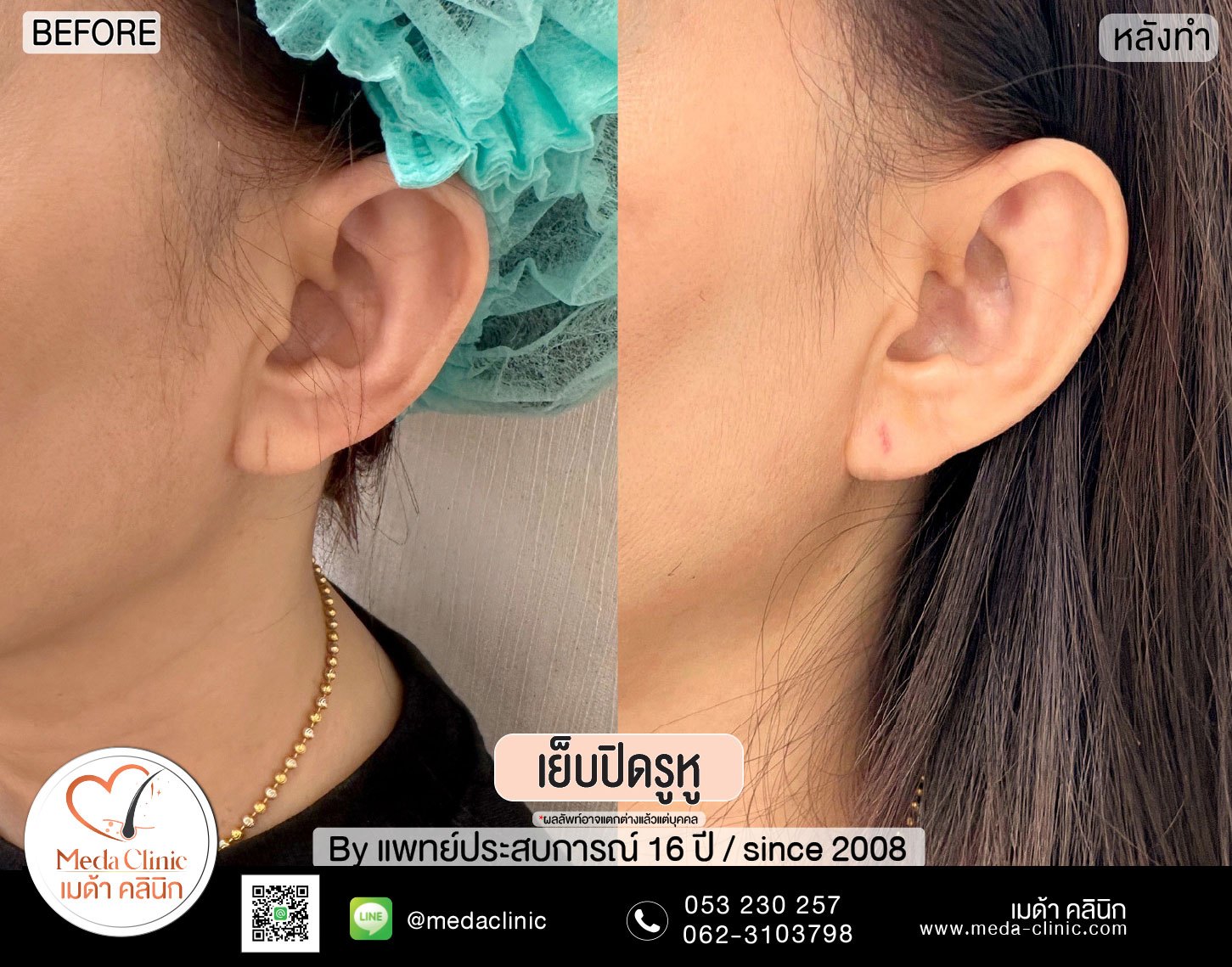 เย็บรูหูที่ไหนดี