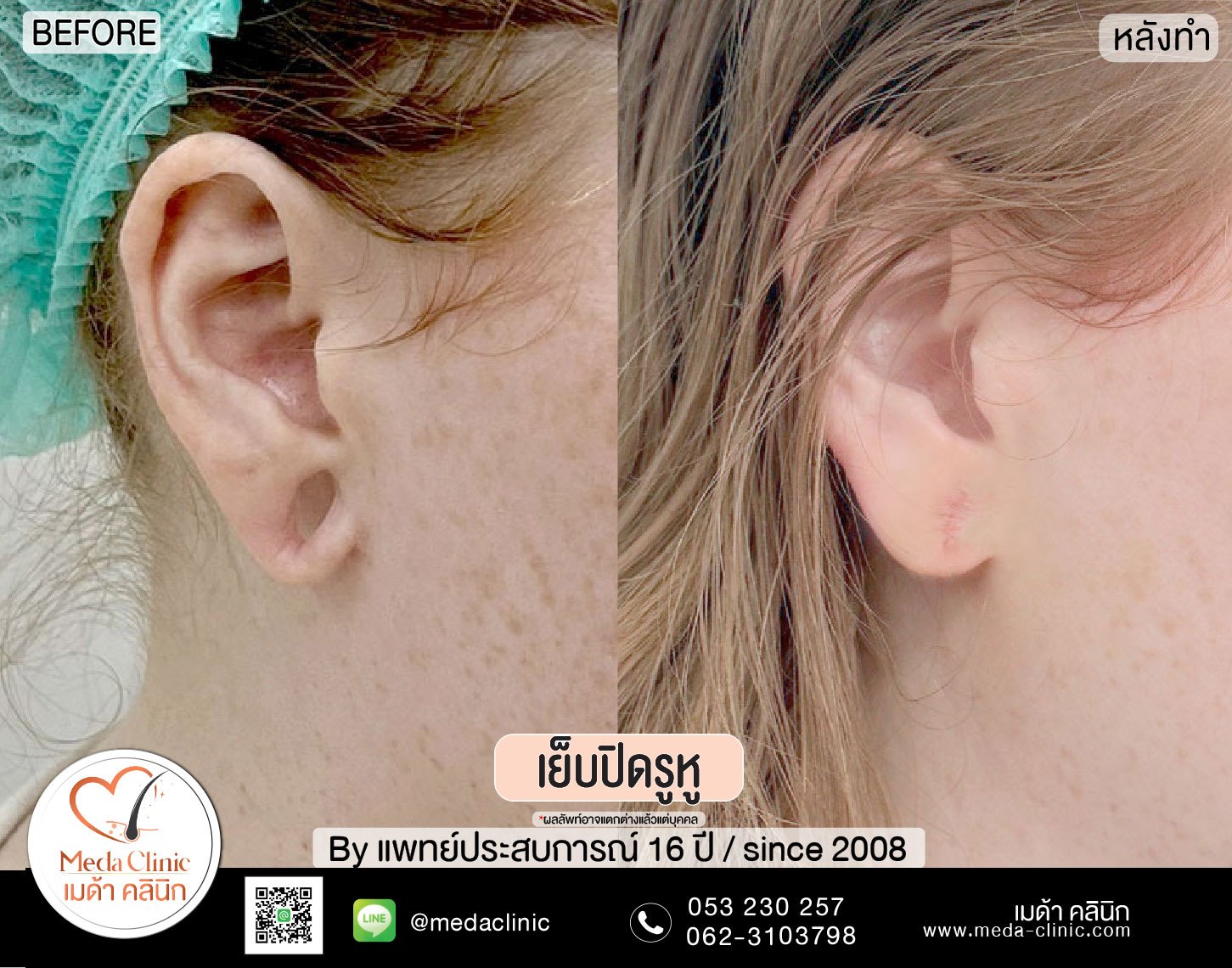 เย็บรูหูที่ไหนดี