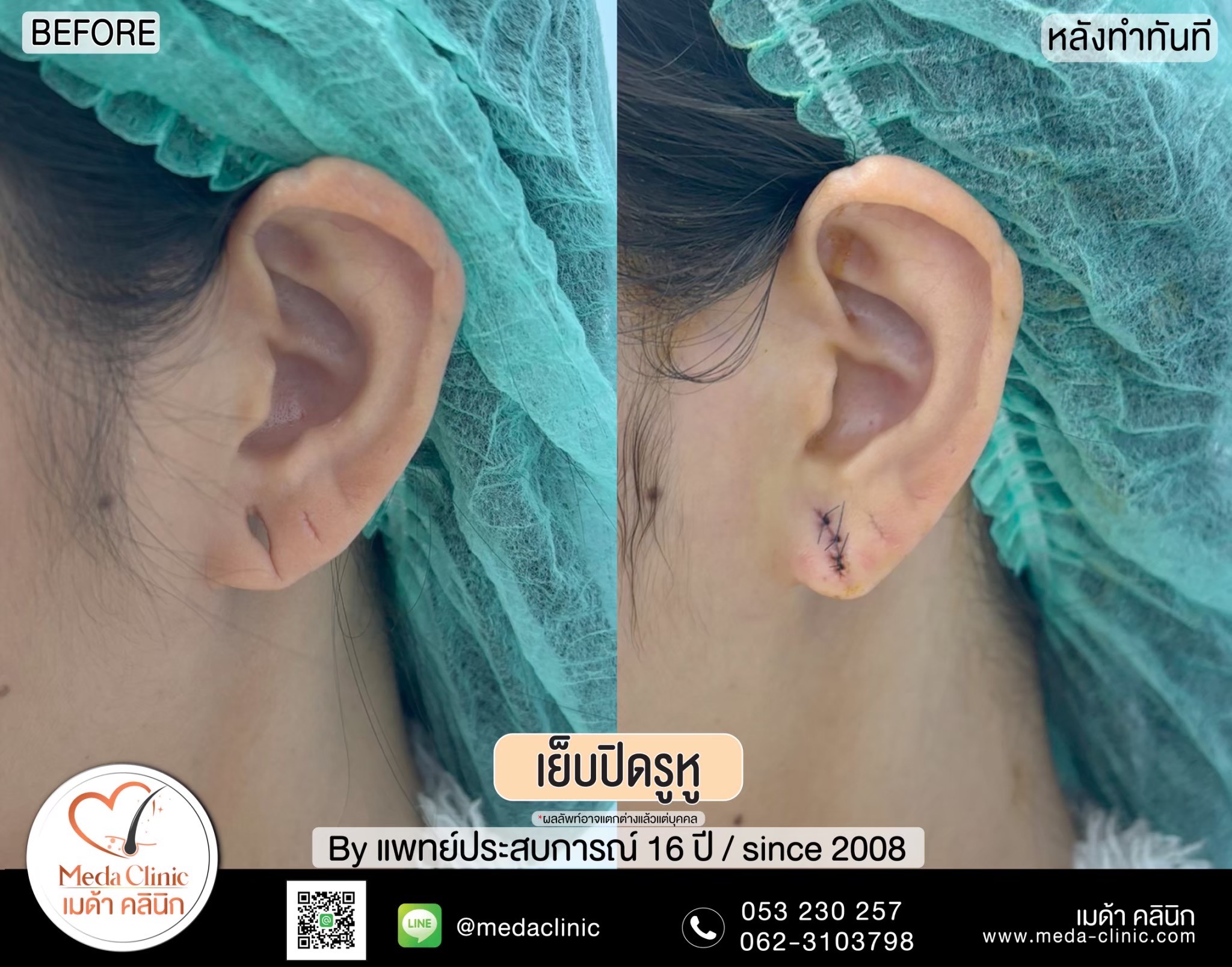 เย็บรูหู
