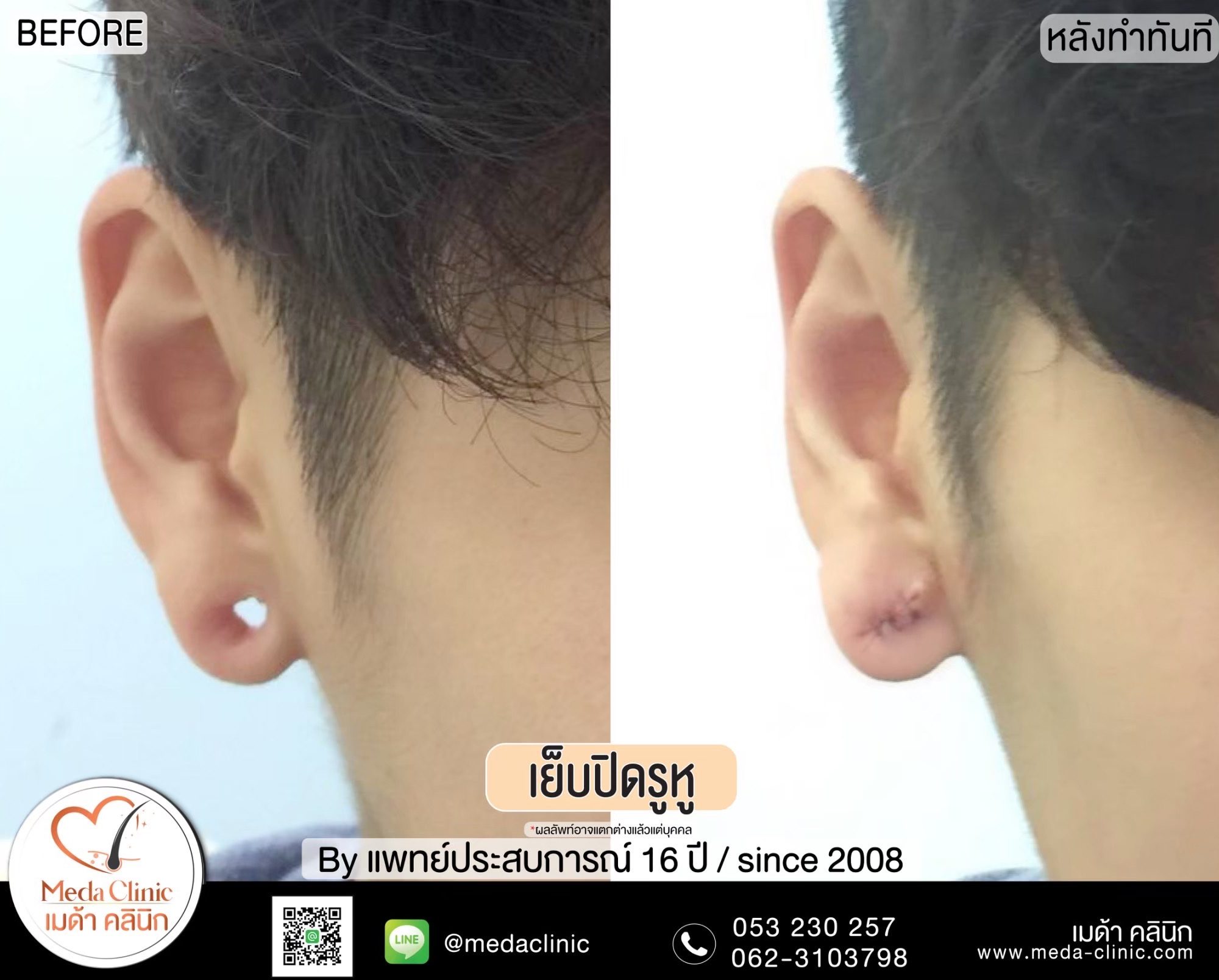 เย็บรูหู